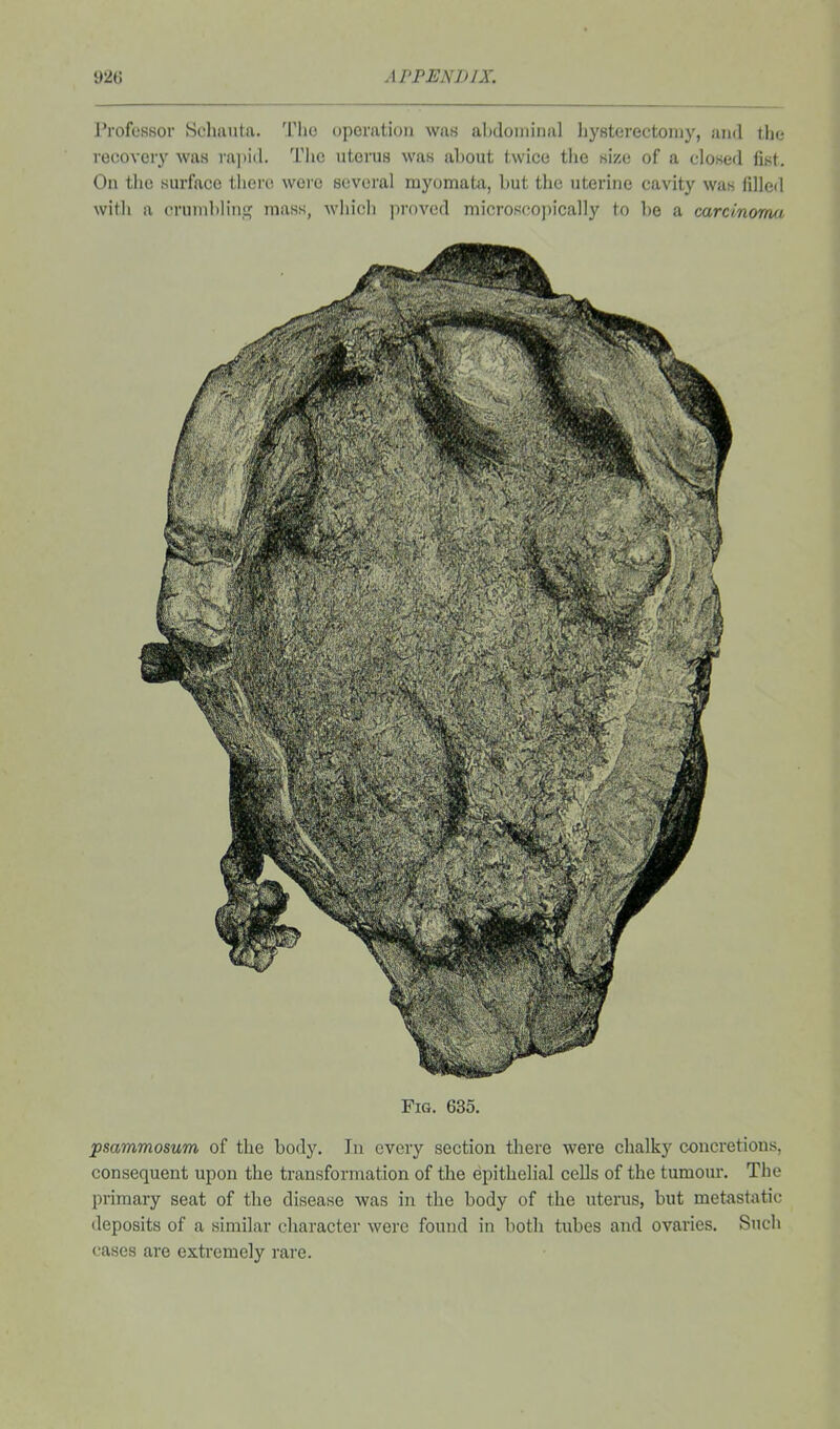 Professor Schauta. Tho operation was al)doniinal hysterectomy, and the recovery was rajiid. Tlic uterus was about twice the size of a closed fist. On the surface there were several myomata, but the uterine cavity was filled with a crumbling mass, which proved microsco])ically to be a cardnonui Fig. 635. psammosum of the body. In every section there were chalky concretions, consequent upon the transformation of the epithelial cells of the tumour. The primary seat of the disease was in the body of the uterus, but metastatic deposits of a similar character were found in both tubes and ovaries. Such cases are extremely I'are.