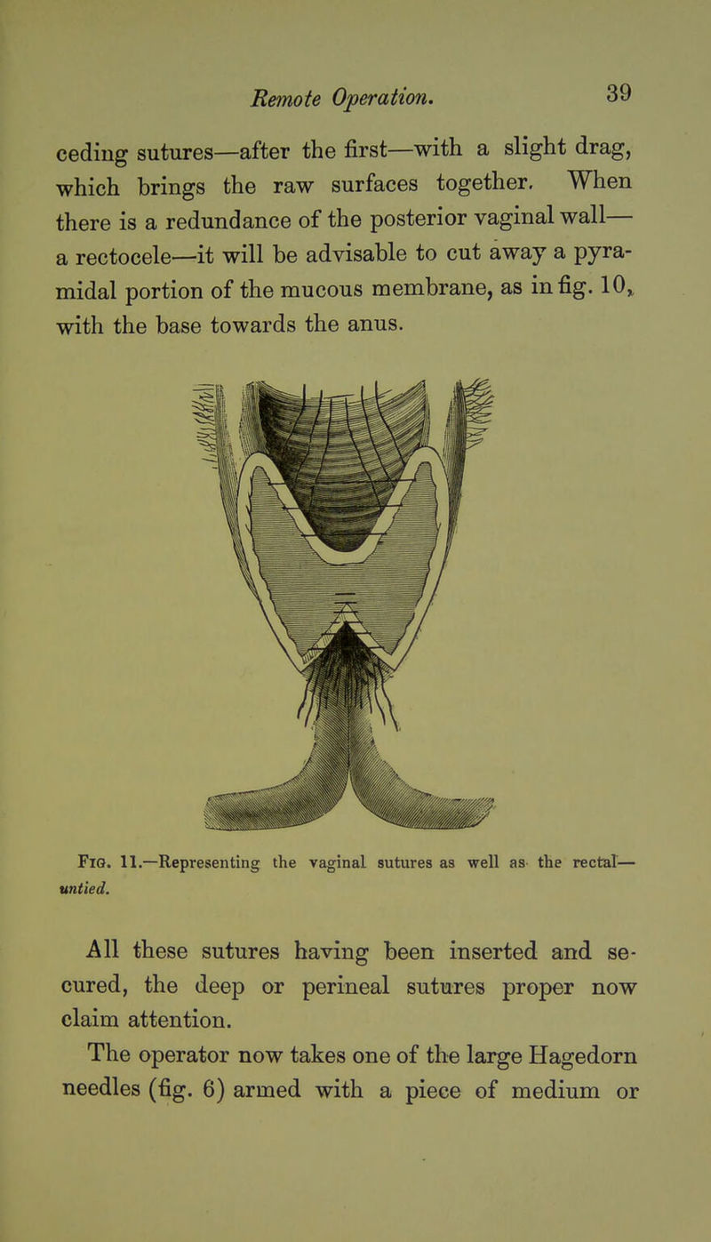 ceding sutures—after the first—with a slight drag, which brings the raw surfaces together. When there is a redundance of the posterior vaginal wall— a rectocele—it will be advisable to cut away a pyra- midal portion of the raucous membrane, as in fig. 10^ with the base towards the anus. Fig. 11.—Representing the vaginal sutures as well as the rectal— untied. All these sutures having been inserted and se- cured, the deep or perineal sutures proper now claim attention. The operator now takes one of the large Hagedorn needles (fig. 6) armed with a piece of medium or