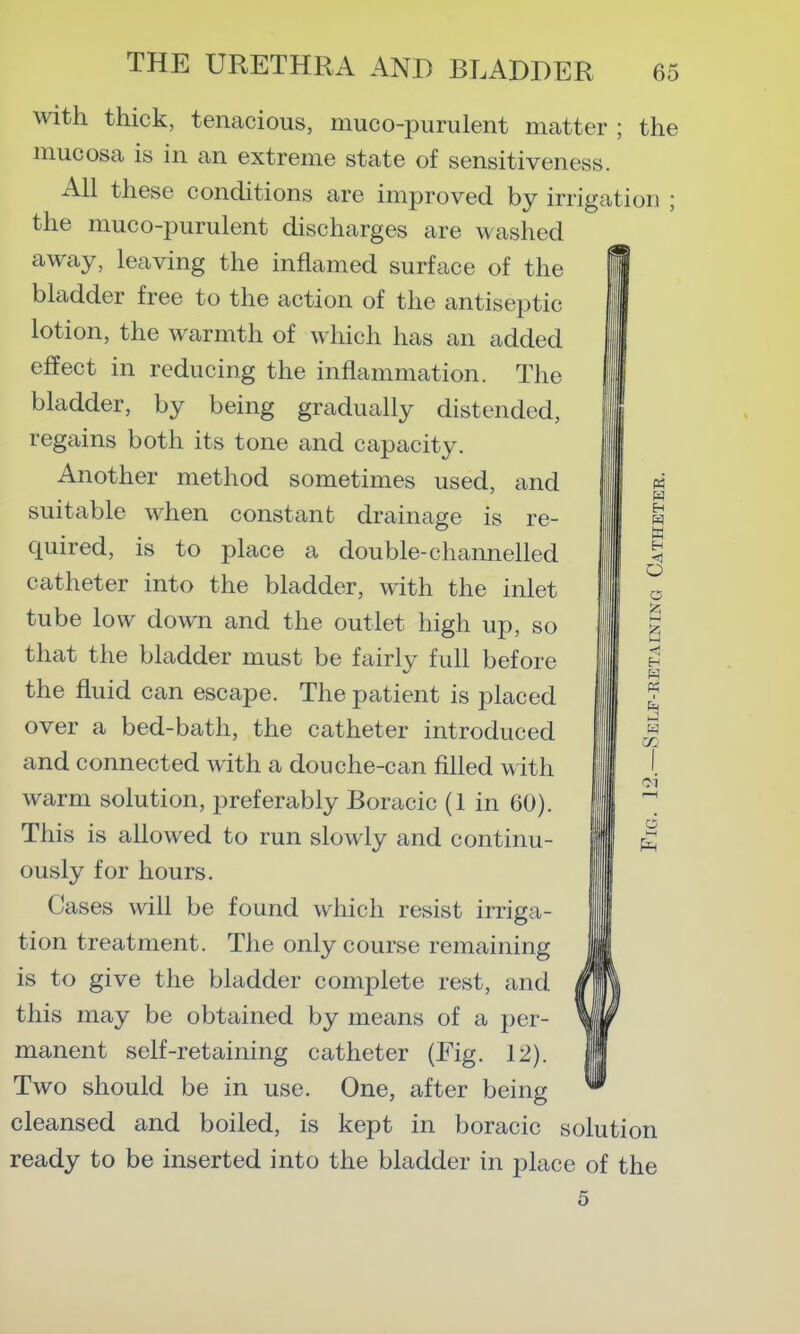 with thick, tenacious, muco-purulent matter ; the mucosa is in an extreme state of sensitiveness. All these conditions are improved by irrigation ; the muco-purulent discharges are washed away, leaving the inflamed surface of the bladder free to the action of the antiseptic lotion, the warmth of which has an added effect in reducing the inflammation. The bladder, by being gradually distended, regains both its tone and capacity. Another method sometimes used, and III « I In ^ suitable when constant drainage is re- I U quired, is to place a double-channelled catheter into the bladder, with the inlet tube low down and the outlet high up, so that the bladder must be fairly full before | the fluid can escape. The patient is placed over a bed-bath, the catheter introduced and connected with a douche-can filled with warm solution, preferably Boracic (1 in 60). This is allowed to run slowly and continu- ously for hours. Cases will be found which resist irriga- tion treatment. The only course remaining is to give the bladder complete rest, and this may be obtained by means of a per- manent self-retaining catheter (Fig. 12). Two should be in use. One, after being cleansed and boiled, is kept in boracic solution ready to be inserted into the bladder in place of the 5 o o 01