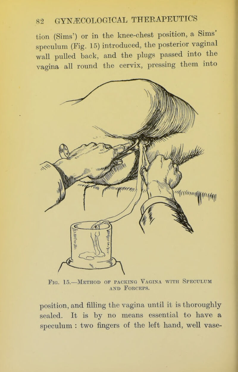 tion (Sims') or in the knee-chest position, a Sims' speculum (Fig. 15) introduced, the posterior vaginal wall pulled back, and the plugs passed into the vagina all round the cervix, pressing them into Pig. 15.—Method of PACiaNO Vagina with Speculum AND Forceps. position, and filling the vagina until it is thoroughly- sealed. It is by no means essential to have a speculum : two fingers of the left hand, well vase-