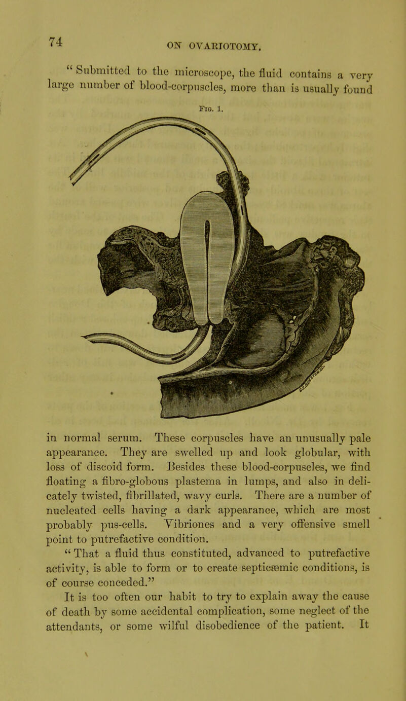  Submitted to the microscope, the fluid contains a very arge number of blood-corpuscles, more tlian is usually found Fig. 1. in normal serum. These corpuscles have an unusually pale appearance. They are swelled up and look globular, with loss of discoid form. Besides these blood-corpuscles, we find floating a fibro-globous plastema in lumps, and also in deli- cately twisted, fibrillated, wavy cm-Is. There are a number of nucleated cells having a dark appearance, which are most probably pus-cells. Yibriones and a very ofiensive smell point to putrefactive condition.  That a fluid thus constituted, advanced to jjutrefactive activity, is able to form or to create septiceemic conditions, is of course conceded. It is too often our habit to try to explain away the cause of death by some accidental complication, some neglect of the attendants, or some wilful disobedience of the patient. It \