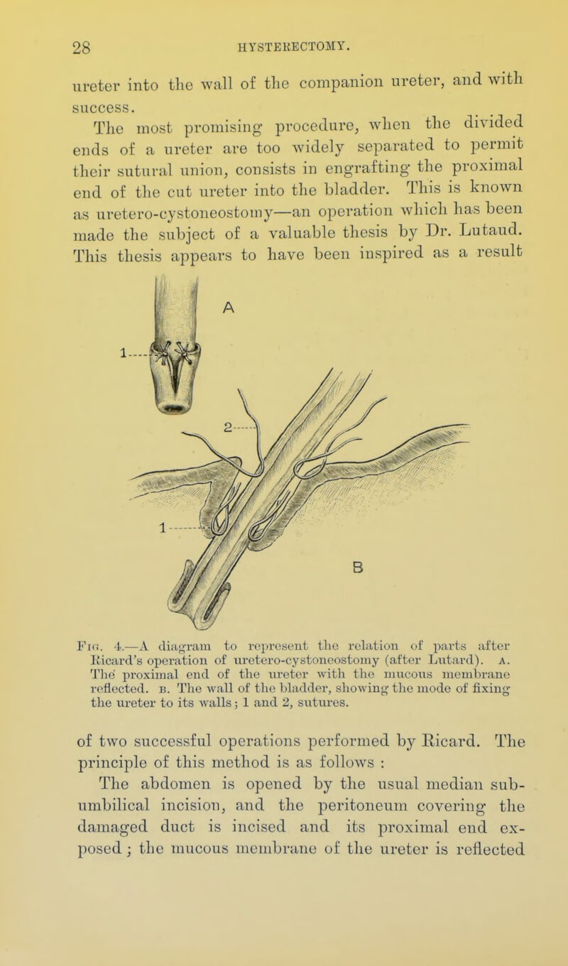 ureter into the Avail of the companion ureter, and with success. The most promising procedure, when the divided ends of a ureter are too widely separated to permit their sutural union, consists in engrafting the proximal end of the cut ureter into the bladder. This is known as uretero-eystoneostomy—an operation which has been made the subject of a valuable thesis by Dr. Lutaud. This thesis appears to have been inspired as a result Fi<i. 4.—A diagram to represent the relation of parts after Ricard's operation of uretero-eystoneostomy (after Lutard). A. 'Die proximal end of the ureter with the mucous membrane reflected, b. The wall of the bladder, showing the mode of fixing the ureter to its walls; 1 and 2, sutures. of two successful operations performed by Bicard. The principle of this method is as follows : The abdomen is opened by the usual median sub- umbilical incision, and the peritoneum covering the damaged duct is incised and its proximal end ex- posed ; the mucous membrane of the ureter is reflected