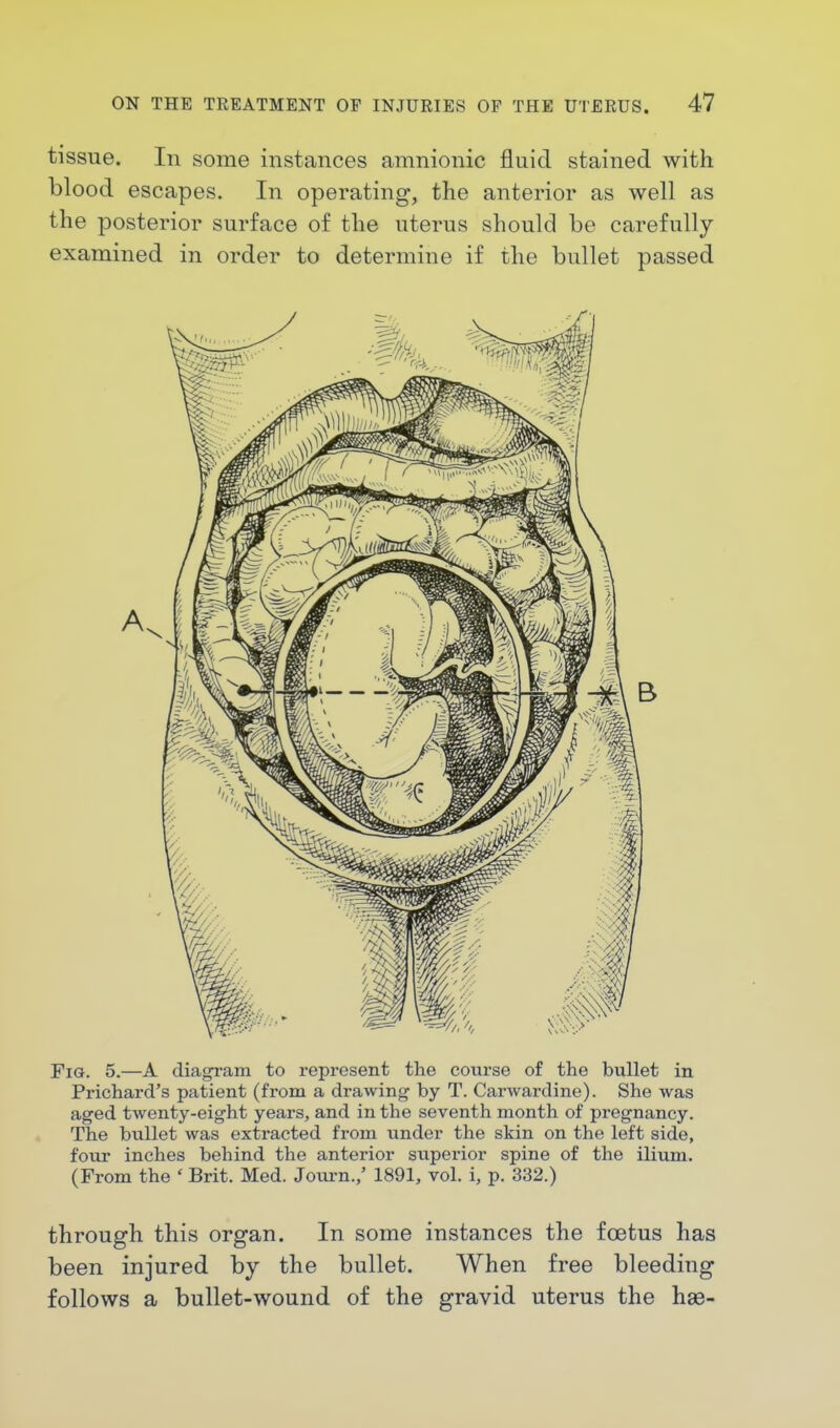 tissue. In some instances amnionic fluid stained with blood escapes. In operating, the anterior as well as the posterior surface of the uterus should be carefully examined in order to determine if the bullet passed Fig. 5.—A diagram to represent the course of the bullet in Prichard's patient (from a drawing by T. Carwardine). She was aged twenty-eight years, and in the seventh month of pregnancy. The bullet was extracted from under the skin on the left side, four inches behind the anterior superior spine of the ilium. (From the * Brit. Med. Journ.,' 1891, vol. i, p. 332.) through this organ. In some instances the foetus has been injured by the bullet. When free bleeding follows a bullet-wound of the gravid uterus the hse-