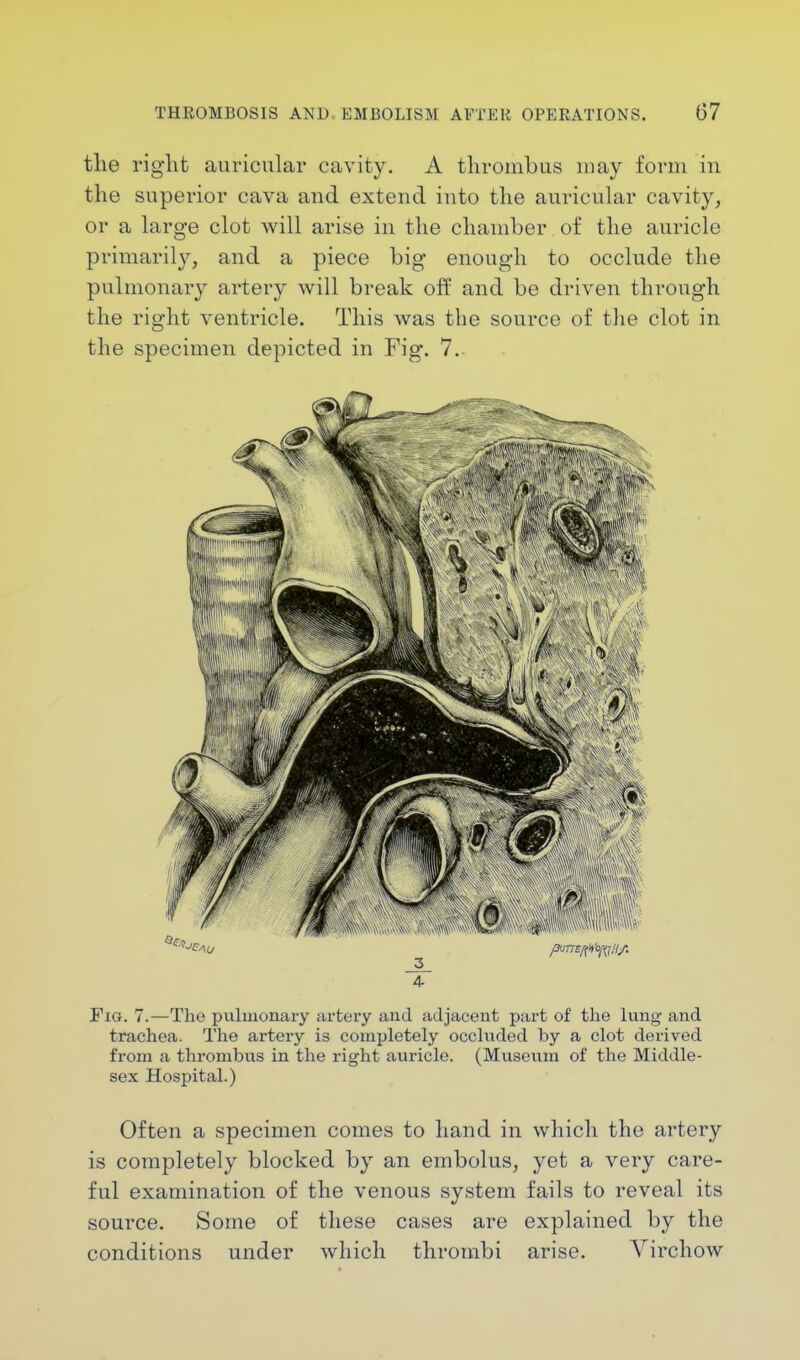 the right auricular cavity. A thrombus may form in the superior cava and extend into the auricular cavity, or a large clot will arise in the chamber of the auricle primarily, and a piece big enough to occlude the pulmonary artery will break off and be driven through the right ventricle. This was the source of the clot in the specimen depicted in Fig. 7. 4- Fig. 7.—The pulmonary artery and adjacent part of the lung and trachea. The artery is completely occluded by a clot derived from a thrombus in the right auricle. (Museum of the Middle- sex Hospital.) Often a specimen comes to hand in which the artery is completely blocked by an embolus, yet a very care- ful examination of the venous system fails to reveal its source. Some of these cases are explained by the conditions under which thrombi arise. Virchow