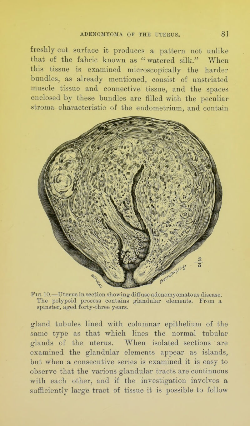 freshly cut surface it produces a pattern not unlike that of the fabric known as watered silk. When this tissue is examined microscopically the harder bundles, as already mentioned, consist of unstriated muscle tissue and connective tissue, and the spaces enclosed by these bundles are filled with the peculiar stroma characteristic of the endometrium, and contain Fig. 10.—Uterus in section showing diffuse adenomyomatous disease. The polypoid process contains glandular elements. From a spinster, aged forty-three years. gland tubules lined with columnar epithelium of the same type as that which lines the normal tubular glands of the uterus. When isolated sections are examined the glandular elements appear as islands, but when a consecutive series is examined it is easy to observe that the various glandular tracts are continuous with each other, and if the investigation involves a sufficiently large tract of tissue it is possible to follow