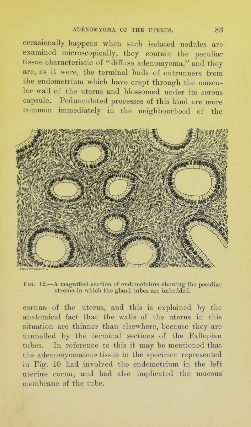 occasionally happens when such isolated nodules are examined microscopically, they contain the peculiar tissue characteristic of diffuse adenomyoma, and they are, as it were, the terminal buds of outrunners from the endometrium which have crept through the muscu- lar wall of the uterus and blossomed under its serous capsule. Pedunculated processes of this kind are more common immediately in the neighbourhood of the Fig. 12.—A magnified section of endometrium showing the peculiar stroma in which the gland tubes are imbedded. cornua of the uterus, and this is explained by the anatomical fact that the walls of the uterus in this situation are thinner than elsewhere, because they are tunnelled by the terminal sections of the Fallopian tubes. In reference to this it may be mentioned that the adenomyomatous tissue in the specimen represented in Fig. 10 had involved the endometrium in the left uterine cornu, and had also implicated the mucous membrane of the tube.