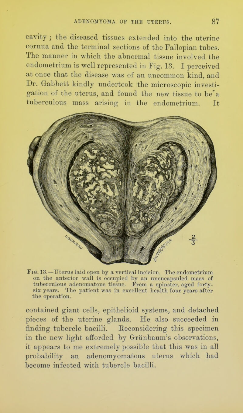 cavity j the diseased tissues extended into the uterine cornua and the terminal sections of the Fallopian tubes. The manner in which the abnormal tissue involved the endometrium is well represented in Fig. 13. I perceived at once that the disease was of an uncommon kind, and Dr. Gabbett kindly undertook the microscopic investi- gation of the uterus, and found the new tissue to be'a tuberculous mass arising in the endometrium. It Fig. 13.—Uterus laid open by a vertical incision. The endometrium on the anterior wall is occupied by an unencapsuled mass of tuberculous adenomatous tissue. From a spinster, aged forty- six years. The patient was in excellent health four years after the operation. contained giant cells, epithelioid systems, and detached pieces of the uterine glands. He also succeeded in finding tubercle bacilli. Reconsidering this specimen in the new light afforded by Grunbaunr's observations, it appears to me extremely possible that this was in all probability an adenomyomatous uterus which had become infected with tubercle bacilli.