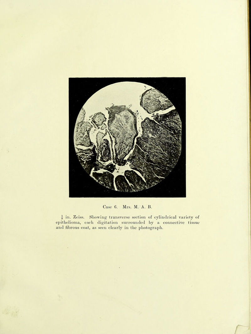 | in. Zeiss. Showing transverse section of cylindrical variety of epithelioma, each digitation surrounded by a connective tissue and fibrous coat, as seen clearly in the photograph.