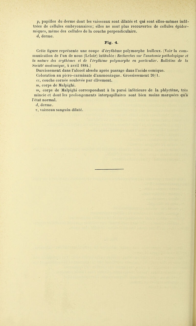 p, papilles du derme dont les vaisseaux sont dilatés et qui sont elles-mêmes infil- trées de cellules embryonnaires; elles ne soat plus recouvertes de cellules épider- miques, même des cellules de la couche perpendiculaire. d, derme. Fig. 4. Cette figure représente une coupe d'érythème polymorphe huileux. (Voir la com- munication de l'un de nous (Leloir) intitulée: Recherches sur ranatomie pathologique et la nature des érythèmes et de Vérythème polymorphe en particulier. Bulletins de la Société anatomique, 4 avril 1884.) Durcissement dans l'alcool absolu après passage dans l'acide osmique. Coloration au picro-carminate d'ammoniaque. Grossissement 20/1. ce, couche cornée soulevée par clivement. m, corps de Malpighi. m, corps de Malpighi correspondant à la paroi inférieure de la phlyctène, très mincie et dont les prolongements interpapillaires sont bien moins marquées qu'à l'état normal. d, derme. r, vaisseau sanguin dilaté.