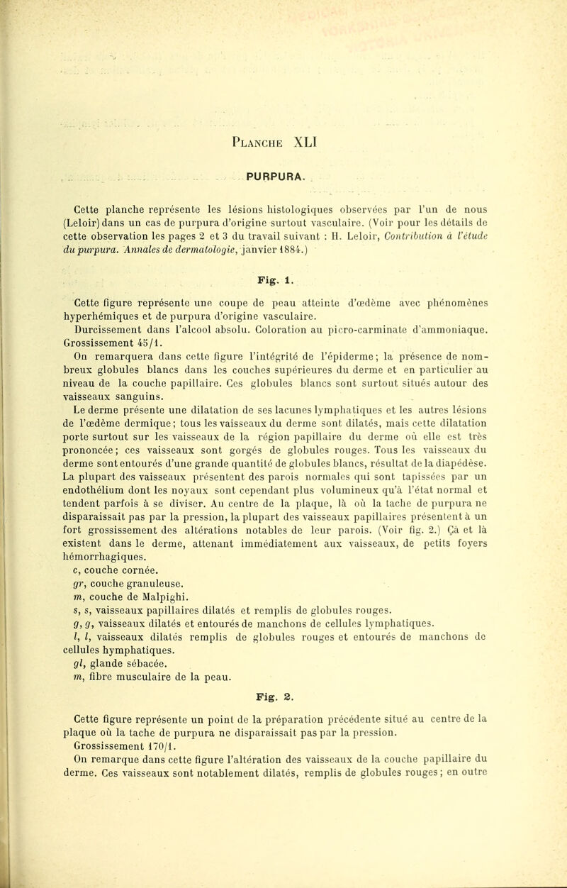 - PURPURA. Cette planche représente les lésions histologiques observées par l'un de nous (Leloir) dans un cas de purpura d'origine surtout vasculaire. (Voir pour les détails de cette observation les pages 2 et 3 du travail suivant : H. Leloir, Conlribulion à l'ùludc du purpura. Annales de dermatologie, janvier 1884.) Fig. 1. Cette figure représente une coupe de peau atteinte d'oedème avec phénomènes hyperhémiques et de purpura d'origine vasculaire. Durcissement dans l'alcool absolu. Coloration au picro-carminate d'ammoniaque. Grossissement 45/1. On remarquera dans cette figure l'intégrité de l'épiderme; la présence de nom- breux globules blancs dans les couches supérieures du derme et en particulier au niveau de la couche papillaire. Ces globules blancs sont surtout situés autour des vaisseaux sanguins. Le derme présente une dilatation de ses lacunes lymphatiques et les autres lésions de l'œdème dermique; tous les vaisseaux du derme sont dilatés, mais cette dilatation porte surtout sur les vaisseaux de la région papillaire du derme où elle est très prononcée; ces vaisseaux sont gorgés de globules rouges. Tous les vaisseaux du derme sont entourés d'une grande quantité de globules blancs, résultat de la diapédèse. La plupart des vaisseaux présentent des parois normales qui sont tapissées par un endothélium dont les noyaux sont cependant plus volumineux qu'à l'état normal et tendent parfois à se diviser. Au centre de la plaque, là où la tache de purpura ne disparaissait pas par la pression, la plupart des vaisseaux papillaires présentent à un fort grossissement des altérations notables de leur parois. (Voir fig. 2.) Çà et là existent dans le derme, attenant immédiatement aux vaisseaux, de petits foyers hémorrhagiques. c, couche cornée. gr, couche granuleuse. m, couche de Malpighi. s, s, vaisseaux papillaires dilatés et remplis de globules rouges. g, g, vaisseaux dilatés et entourés de manchons de cellules lymphatiques. l, l, vaisseaux dilatés remplis de globules rouges et entourés de manchons de cellules hymphatiques. gl, glande sébacée. m, fibre musculaire de la peau. Fig. 2. Cette figure représente un point de la préparation précédente situé au centre de la plaque où la tache de purpura ne disparaissait pas par la pression. Grossissement 170/1. On remarque dans cette figure l'altération des vaisseaux de la couche papillaire du derme. Ces vaisseaux sont notablement dilatés, remplis de globules rouges; en outre