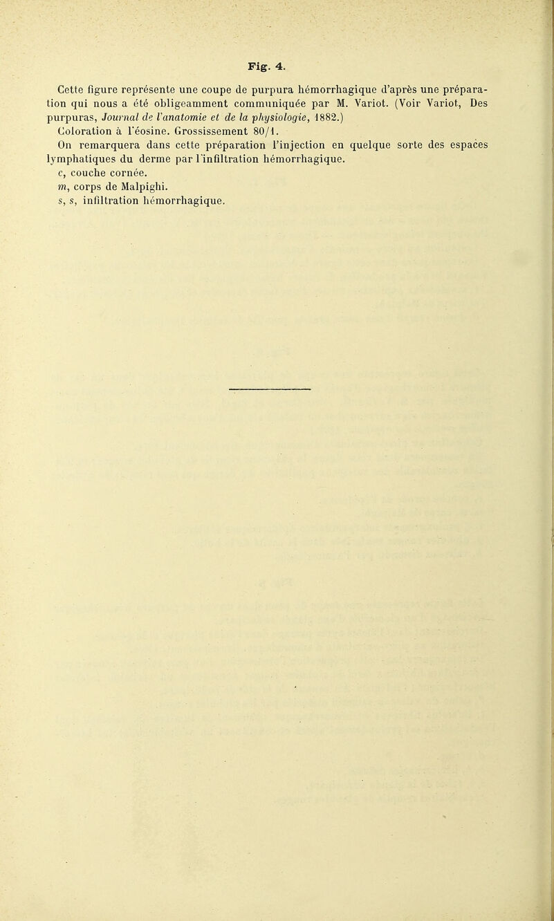 Cette figure représente une coupe de purpura hémorrhagique d'après une prépara- tion qui nous a été obligeamment communiquée par M. Variot. (Voir Variot, Des purpuras, Journal de Vanatomie et de la physiologie, 1882.) Coloration à l'éosine. Grossissement 80/1. On remarquera dans cette préparation l'injection en quelque sorte des espaces lymphatiques du derme par l'infiltration hémorrhagique. c, couche cornée. m, corps de Malpighi. s, s, infiltration hémorrhagique.