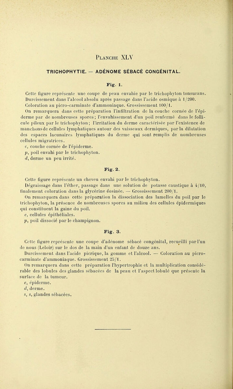 TRICHOPHYTIE. — ADÉNOME SÉBACÉ CONGÉNITAL. Fig. 1. Cette figure représente une coupe de peau envahie par le trichophyton tonsurans. Durcissement dans l'alcool absolu après passage dans l'acide osmique à 1/200. Coloration au picro-carminate d'ammoniaque. Grossissement 100/1. On remarquera dans cette préparation l'infiltration de la couche cornée de l'épi- derme par de nombreuses spores ; l'envahissement d'un poil renfermé dans le folli- cule pileux par le tricliophyton ; l'irritation du derme caractérisée par l'existence de manchons de cellules lymphatiques autour des vaisseaux dermiques, parla dilatation des espaces lacunaires lymphatiques du derme qui sont remplis de nombreuses cellules migratrices. c, couche cornée de l'épiderme. p, poil envahi par le trichophyton. d, derme un peu irrité. Fig. 2. Cette figure représente un cheveu envahi par le trichopliyton. Dégraissage dans l'éther, passage dans une solution de potasse caustique à 4/10, finalement coloration dans la glycérine éosinée. — Grossissement 200/1. On remarquera dans cette préparation la dissociation des lamelles du poil par le trichophyton, la présence de nombreuses spores au milieu des cellules épidermiques qui constituent la gaine du poil. e, cellules épithéliales. p, poil dissocié par le champignon. Fig. 3. Cette figure repi^ésente une coupe d'adénome sébacé congénital, recueilli par l'un de nous (Leloir) sur le dos de la main d'un enfant de douze ans. Durcissement dans l'acide picrique, la gomme et l'alcool. — Coloration au picro- carminate d'ammoniaque. Grossissement 2b/l. On remarquera dans cette préparation l'hypertrophie et la multiplication considé- rable des lobules des glandes sébacées de la peau et l'aspect lobulé que présente la surface de la tumeur. e, épiderme. d, derme. s, s, glandes sébacées.