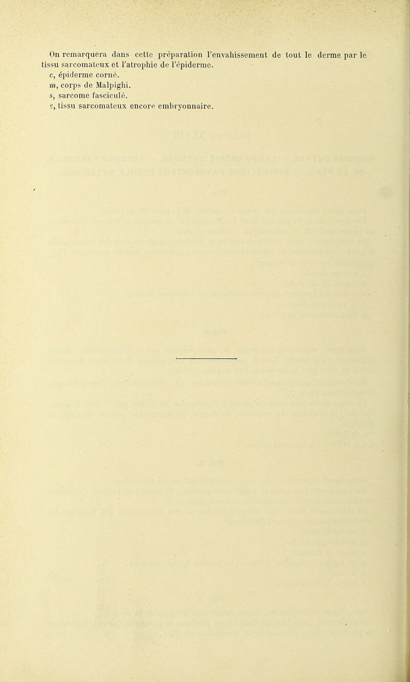 On remarquera dans cette préparation l'envahissement de tout le derme par le tissu sarcomateux et l'atrophie de l'épiderme. c, épiderme corné. m, corps de Malpighi. s, sarcome fasciculé. e, tissu sarcomateux encore embryonnaire.