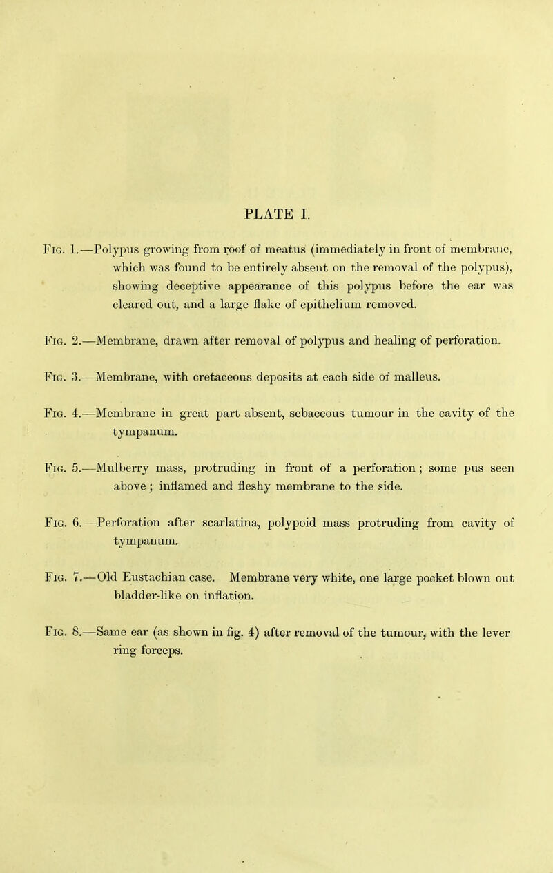 Fig. 1.—Polypus growing from roof of meatus (immediately in front of membrane, which was found to be entirely absent on the removal of the polypus), showing deceptive appearance of this polypus before the ear was cleared out, and a large flake of epithelium removed. Fig. 2.—Membrane, drawn after removal of polypus and healing of perforation. Fig. 3.—Membrane, with cretaceous deposits at each side of malleus. Fig. 4:.—Membrane in great part absent, sebaceous tumour in the cavity of the tympanum. Fig. 5.—Mulberry mass, protruding in front of a perforation; some pus seen above; inflamed and fleshy membrane to the side. Fig. 6.—Perforation after scarlatina, polypoid mass protruding from cavitj^ of tympanum. Fig. 7.—Old Eustachian case. Membrane very white, one large pocket blown out bladder-like on inflation. Fig. 8.—Same ear (as shown in fig. 4) after removal of the tumour, with the lever ring forceps.