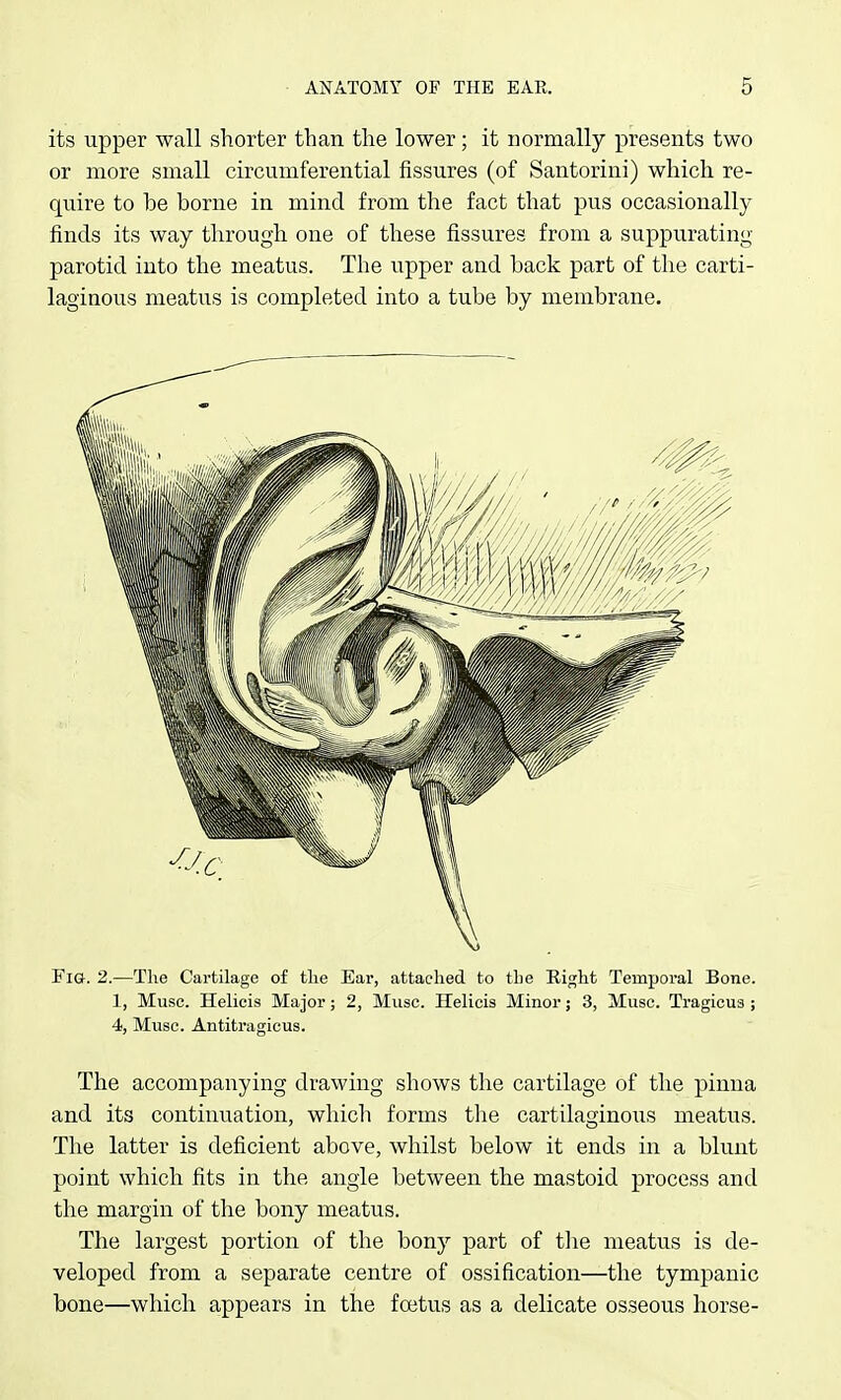 its upper wall shorter than the lower; it normally presents two or more small circumferential fissures (of Santorini) which re- quire to be borne in mind from the fact that pus occasionally finds its way through one of these fissures from a suppurating parotid into the meatus. The upper and back part of the carti- laginous meatus is completed into a tube by membrane. Fig. 2.—The Cartilage of the Ear, attached to the Kight Temporal Bone. 1, Muse. Helicis Major; 2, Muse. Helicis Minor; 3, Muse. Tragicus ; 4, Muse. Antitragicus. The accompanying drawing shows the cartilage of the pinna and its continuation, which forms tlie cartilaginoiis meatus. The latter is deficient above, whilst below it ends in a blunt point which fits in the angle between the mastoid process and the margin of the bony meatus. The largest portion of the bony part of tlie meatus is de- veloped from a separate centre of ossification—the tympanic bone—which appears in the foetus as a delicate osseous horse-