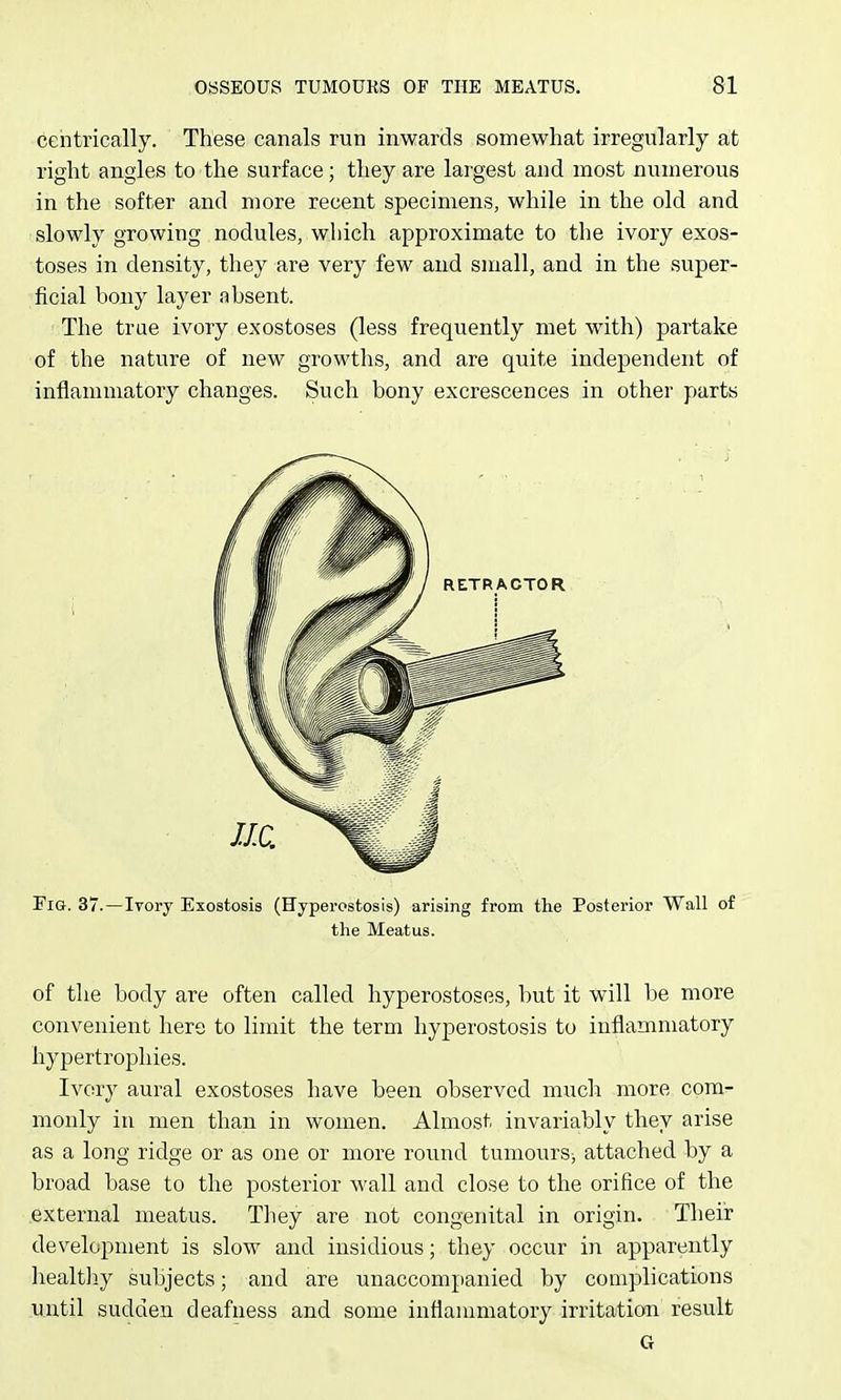 centrically. These canals run inwards somewhat irregularly at right angles to the surface; they are largest and most numerous in the softer and more recent specimens, while in the old and slowly growing nodules, which approximate to the ivory exos- toses in density, they are very few and small, and in the super- ficial bony layer absent. The true ivory exostoses (less frequently met with) partake of the nature of new growths, and are quite independent of inflammatory changes. Such bony excrescences in other parts Fig. 37.—Ivory Exostosis (Hyperostosis) arising from the Posterior Wall of the Meatus. of the body are often called hyperostoses, but it will be more convenient here to limit the term hyperostosis to inflammatory hypertrophies. Ivory aural exostoses have been observed much more com- monly in men than in women. Almost invariably they arise as a long ridge or as one or more round tumours^ attached by a broad base to the posterior wall and close to the orifice of the external meatus. They are not congenital in origin. Their development is slow and insidious; they occur in apparently liealtliy subjects; and are unaccompanied by complications until sudden deafness and some inflammatory irritation result G