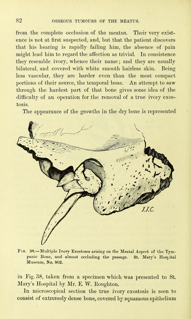 from the complete occlusion of the meatus. Their very exist- ence is not at first suspected, and, but that the patient discovers that his hearing is rapidly failing him, the absence of pain might lead him to regard the affection as trivial. In consistence they resemble ivory, whence their name; and they are usually bilateral, and covered with white smooth hairless skin. Being less vascular, they are harder even than the most compact portions of their source, the temporal bone. An attempt to saw through the hardest part of that bone gives some idea of the ditficulty of an operation for the removal of a true ivory exos- tosis. The appearance of the growths in the dry bone is represented Fig. 38.—Multiple Ivory Exostoses arising on the Meatal Aspect of the Tym- panic Bone, and almost occluding the passage. St. Mary's Hospital Museum, No. 802, in Fig. 38, taken from a specimen which was presented to St. Mary's Hospital by Mr. E. W. Eoughton. In microscopical section the true ivory exostosis is seen to consist of extremely dense bone, covered by squamous epithelium