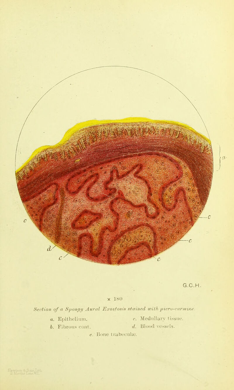 G.C.H. X l!SO Section of a Sponqt/ Awrd Exostosis stained with piero-carmine. a. EiiitlicliMiii. c. Medullary t issue. b. Fibrous ( out. d. Blood vc^sscls. e. Bone t rabecuhe.