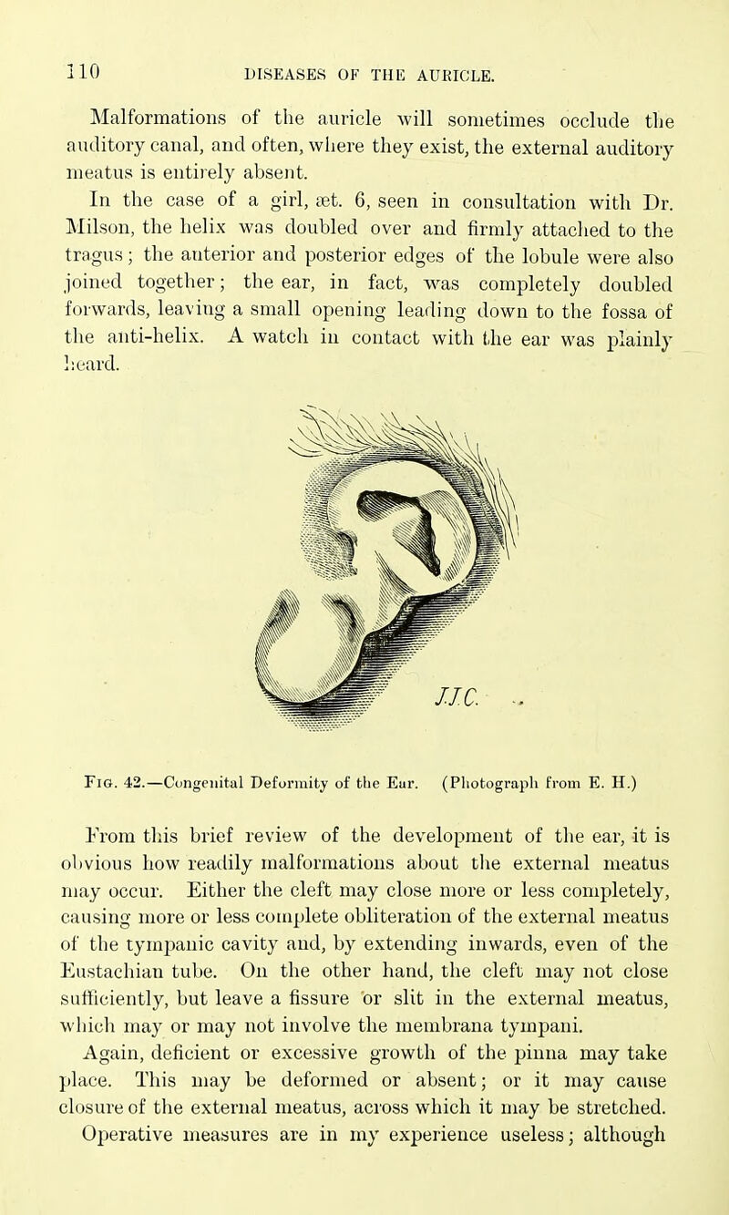 Malformations of the auricle will sometimes occlude tlie auditory canal, and often, wliere they exist, the external auditory meatus is entirely absent. In the case of a girl, tet. 6, seen in consultation with Dr. Milson, the helix was doubled over and firmly attached to the tragus; the anterior and posterior edges of the lobule were also joined together; the ear, in fact, was completely doubled forwards, leaving a small opening leading down to the fossa of the anti-helix. A watch in contact with the ear was plainly l;eard. Fig. 42.—Congenital Deformity of the Eur. (Pliotograpli from E. H.) From this brief review of the development of the ear, it is obvious how readily malformations about tlie external meatus may occur. Either the cleft may close more or less completely, causing more or less complete obliteration of the external meatus of the tympanic cavity and, by extending inwards, even of the Eustachian tube. On the other hand, the cleft may not close sufficiently, but leave a fissure or slit in the external meatus, which may or may not involve the membrana tympani. Again, deficient or excessive growth of the pinna may take place. This may be deformed or absent; or it may cause closure of the external meatus, across which it may be stretched. Operative measures are in my experience useless; although