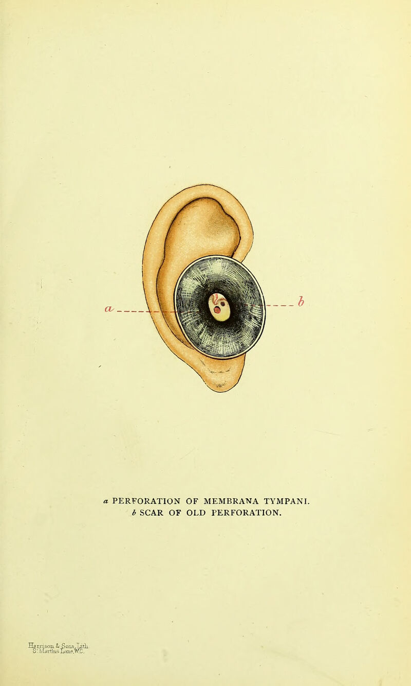 a PERFORATION OF MEMBRANA TYMPANI. b SCAR OF OLD PERFORATION.