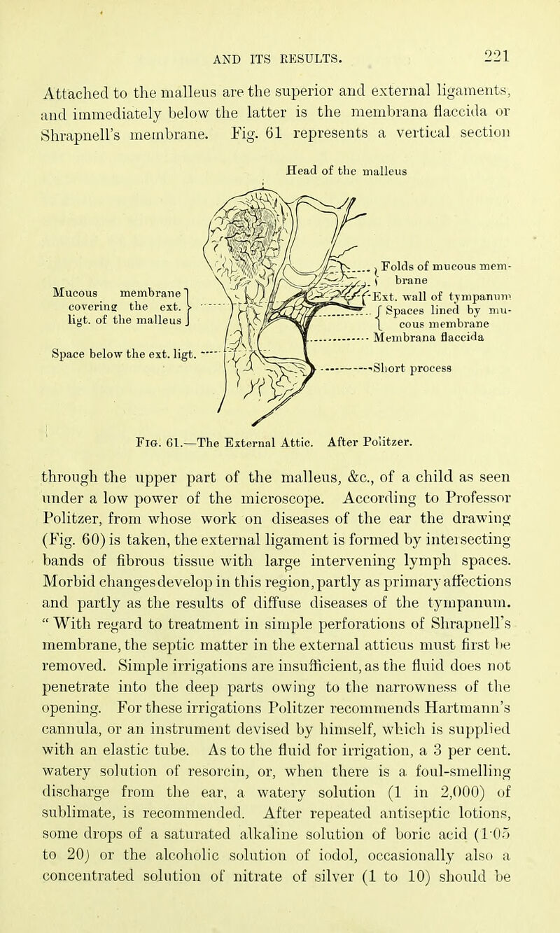 Attached to the malleus are the superior and external ligaments, and immediately below the latter is the membrana flaccida or Shrapnell's membrane. Tig. 61 represents a vertical section Head of the malleus Fig. 61.—The External Attic. After Politzer. through the upper part of the malleus, &c., of a child as seen under a low power of the microscope. According to Professor Politzer, from whose work on diseases of the ear the drawing (Fig. 60) is taken, the external ligament is formed by inteisecting bands of fibrous tissue with large intervening lymph spaces. Morbid changes develop in this region,partly as primary affections and partly as the results of diffuse diseases of the tympanum.  With regard to treatment in simple perforations of Shrapnell's membrane, the septic matter in the external atticus must first be removed. Simple irrigations are insufficient, as the fluid does not penetrate into the deep parts owing to the narrowness of the opening. For these irrigations Politzer recommends Hartmann's cannula, or an instrument devised by himself, which is supplied with an elastic tube. As to the fluid for irrigation, a 3 per cent, watery solution of resorcin, or, when there is a foul-smelling discharge from the ear, a wat(3ry solution (1 in 2,000) of sublimate, is recommended. After repeated antiseptic lotions, some drops of a saturated alkaline solution of boric acid (105 to 20) or the alcoholic solution of iodol, occasionally also a concentrated solution of nitrate of silver (1 to 10) should be