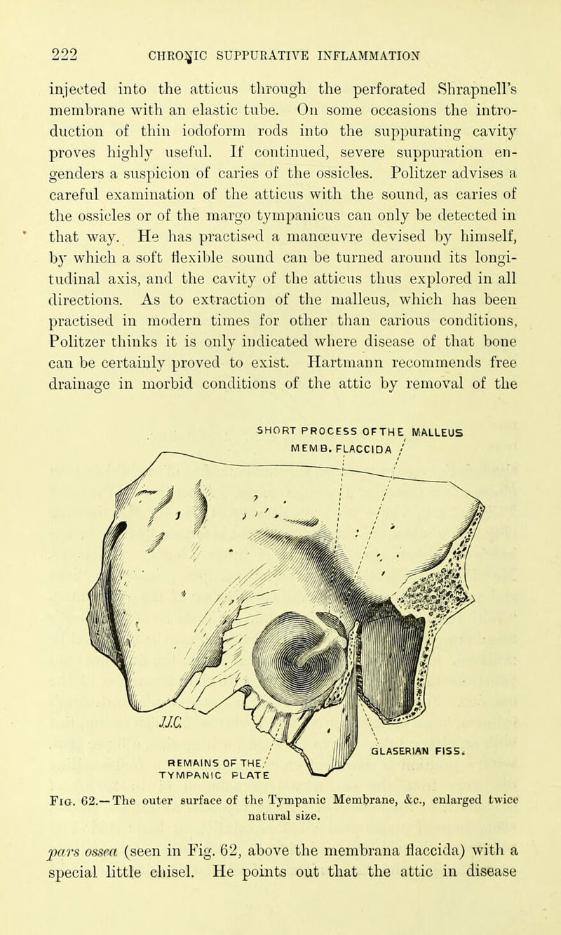 injected into the atticus throi^gli the perforated Shrapnell's membrane with an elastic tube. On some occasions the intro- duction of thin iodoform rods into the suppurating cavity proves highly useful. If contiimed, severe suppuration en- genders a suspicion of caries of the ossicles. Politzer advises a careful examination of the atticus with the sound, as caries of the ossicles or of the margo tympanicus can only be detected in that way. He Iras practised a manoeuvre devised by himself, by which a soft Hexible sound can be turned around its longi- tudinal axis, and the cavity of the atticus thus explored in all directions. As to extraction of tlie malleus, which has been practised in modern times for other than carious conditions, Politzer thinks it is only indicated where disease of that bone can be certainly proved to exist. Hartmann recommends free drainage in morbid conditions of the attic by removal of the SHORT PROCESS OFTHE MALLEUS Fro. 62.— The outer surface of the Tympanic Membrane, &c., enlarged twice natural size. pars ossea (seen in Fig. 62, above the membrana flaccida) witli a special little chisel. He points out that the attic in disease