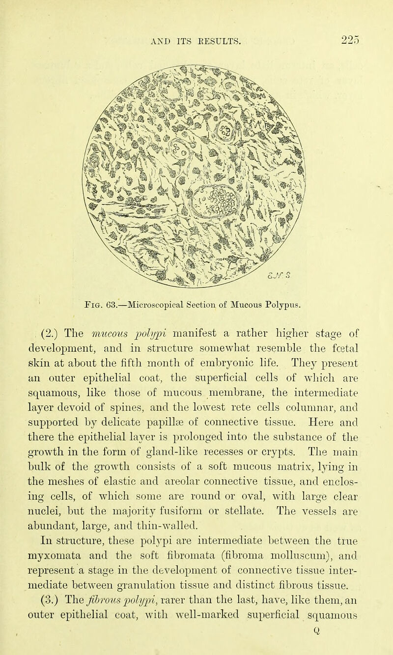 Pig. 63.—Microscopical Section of Mucous Polypus. . (2.) The mucotis polypi manifest a rather higher stage of development, and in structure somewhat resemhle the fcetal skin at about the fifth month of embryonic life. They present an outer epithelial coat, the superficial cells of wliich are squamous, like those of mucous membrane, the intermediate layer devoid of spines, and the lowest rete cells columnar, and supported by delicate papilhe of connective tissue. Here and there the epithelial layer is prolonged into the substance of the growth in the form of gland-like recesses or crypts. The main bulk of the growth consists of a soft mucous matrix, lying in the meshes of elastic and areolar connective tissue, and enclos- ing cells, of which some are round or oval, with large clear nuclei, but the majority fusiform or stellate. The vessels are abundant, large, and thin-walled. In structure, these polypi are intei-mediate between the true myxomata and the soft fibromata (fibroma molluscum), and represent a stage in the development of connective tissue inter- mediate between granulation tissue and distinct filjrous tissue. (3.) The fihrous polypi, rarer than the last, have, like them, an outer epithelial coat, with well-marked superficial squamous Q