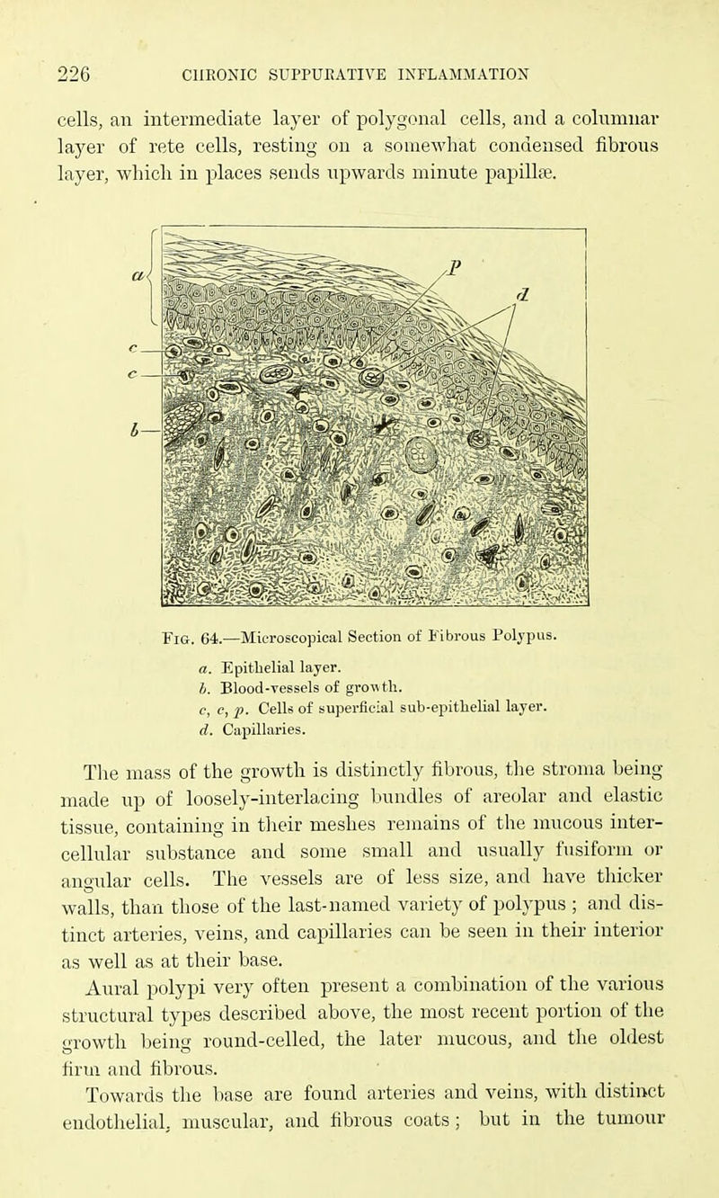 cells, an intermediate layer of polygonal cells, and a colnmnar layer of rete cells, resting on a somewhat condensed fibrous layer, whicli in places sends upwards minute papillse. Fig. 64.—Microscopical Section of Fibrous Polypus. a. Epithelial layer. h. Blood-vessels of grov tli. c, c, ]). Cells of superficial sub-epithelial layer. d. Capillaries. The mass of the growth is distinctly fibrous, the stroma being made up of loosely-interlacing bundles of areolar and elastic tissue, containing in tlieir meshes remains of the mucous inter- cellular substance and some small and usually fusiform or angular cells. The vessels are of less size, and have thicker walls, than those of the last-named variety of polypus ; and dis- tinct arteries, veins, and capillaries can be seen in their interior as well as at their base. Aural polypi very often present a combination of the various structural types described above, the most recent portion of the growth being round-celled, the later mucous, and the oldest firm and fibrous. Towards the base are found arteries and veins, with distinct endothelial, muscular, and fibrous coats; but in the tumour