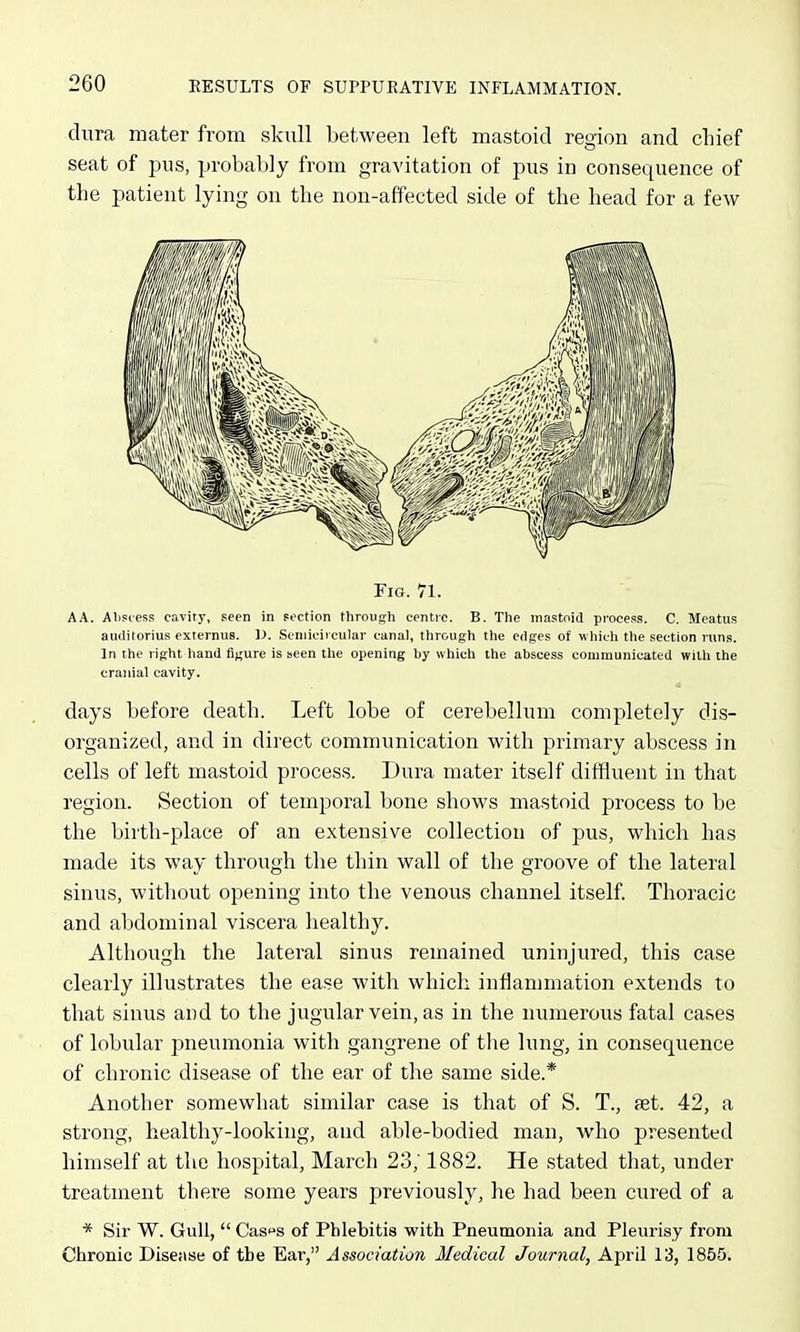 dura mater from skull between left mastoid region and chief seat of pus, probably from gravitation of pus in consequence of the patient lying on the non-affected side of the head for a few Fig. 71. A A. Alipcess cavity, seen in section througli centre. B. The mastoid pi-ocess. C. Meatus auditorius externus. ]>. Stniicircular canal, tlirough tlie edges of whiuli tlie section runs. In the right hand figure is seen the opening by which the abscess communicated with the cranial cavity. days before death. Left lobe of cerebellum completely dis- organized, and in direct communication with primary abscess in cells of left mastoid process. Dura mater itself diffluent in that region. Section of temporal bone shows mastoid process to be the birth-place of an extensive collection of pus, which has made its way through the thin wall of the groove of the lateral sinus, witliout opening into the venous channel itself Thoracic and abdominal viscera healthy. Although the lateral sinus remained uninjured, this case clearly illustrates the ease with which inflammation extends to that sinus and to the jugular vein, as in the numerous fatal cases of lobular pneumonia with gangrene of the lung, in consequence of chronic disease of the ear of the same side.* Another somewhat similar case is that of S. T., aet. 42, a strong, healthy-looking, and able-bodied man, who presented himself at the hospital, March 23; 1882. He stated that, under treatment there some years previously, he had been cured of a * Sir W. Gull,  Gusi^a of Phlebitis with Pneumonia and Pleurisy from Chronic Disease of the Ear, Association 3/edical Journal, April 13, 1855.