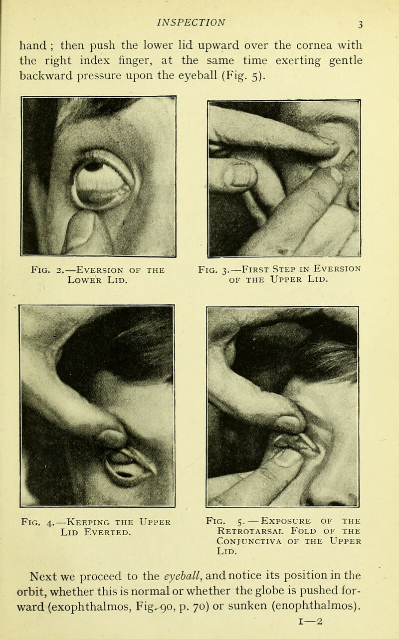 hand ; then push the lower Hd upward over the cornea with the right index finger, at the same time exerting gentle backward pressure upon the eyeball (Fig. 5). Fig. 2.—EvERSioN of the Fig. 3.—First Step in Eversion Lower Lid. of the Upper Lid. Fig. 4.—Keeping THE Upper Fig. 5.—Exposure of the Lid Everted. Retrotarsai, Fold of the Conjunctiva of the Upper Lid. Next we proceed to the eyeball, and notice its position in the orbit, whether this is normal or whether the globe is pushed for- ward (exophthalmos, Fig. 90, p. 70) or sunken (enophthalmos). I—2