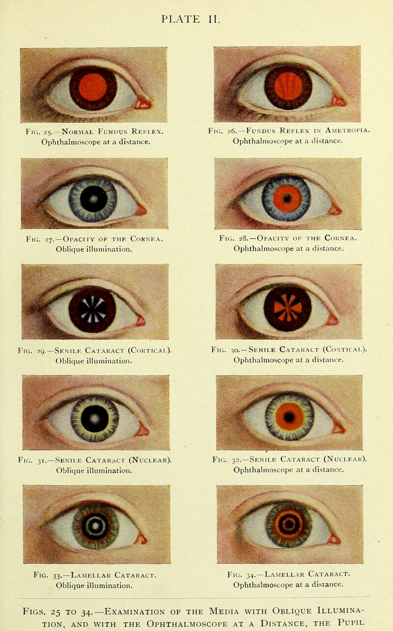 PLATE II. Fig. 25.—Normal Fundus Rei i.f.x. Ophthalmoscope at a distance. Fig. 27.—Opacity of thf. Cornea. Oblique illuiTiination. Fig. 29.—Senile Cataract (Cortical). Oblique illumination. Fig. 31.—Senile Cataract (Nuclear). Oblique illumination. Fig. 33.—Lamellar Cataract. Oblique illumination. Fic;. 26.—Fundus Ki,i ii \ in Ami-. 1 K'H'IA. Ophthalmoscope at a distance. Fig. 28.—Opacity op the Cornea. Ophthalmoscope at a tlistance. Fig. 30.—Senile Cataract (Cortical). Ophthalmoscope at a distance. Fig. 32.—Senile Cataract (Nuclear). Ophthalmoscope at a distance. Fig. 34.—Lamellar Cataract. Ophthalmoscope at a distance. Figs. 25 to 34.—Examination of the Media with Oblique Illumina- tion, AND WITH the OPHTHALMOSCOPE AT A DISTANCE, THE PUPIL