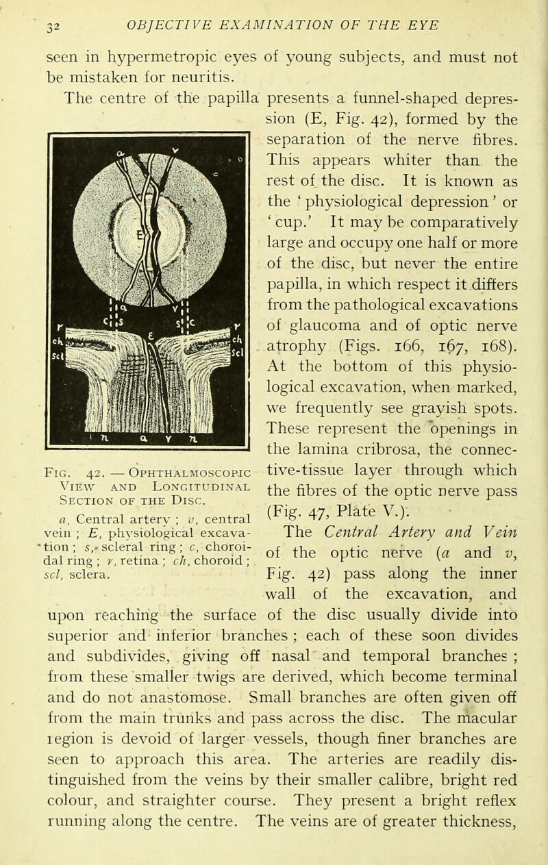 seen in hypermetropic eyes of young subjects, and must not be mistaken for neuritis. The centre of the papilla presents a funnel-shaped depres- sion (E, Fig. 42), formed by the separation of the nerve fibres. This appears whiter than the rest of the disc. It is known as the ' physiological depression' or ' cup.' It may be comparatively large and occupy one half or more of the disc, but never the entire papilla, in which respect it differs from the pathological excavations of glaucoma and of optic nerve atrophy (Figs. 166, 167, 168). At the bottom of this physio- logical excavation, when marked, we frequently see grayish spots. These represent the openings in the lamina cribrosa, the connec- tive-tissue layer through which the fibres of the optic nerve pass (Fig. 47, Plate V.). The Central Artery and Vein of the optic nerve {a and v, Fig. 42) pass along the inner wall of the excavation, and upon reaching the surface of the disc usually divide into superior and inferior branches ; each of these soon divides and subdivides, giving off nasal and temporal branches ; from these smaller twigs are derived, which become terminal and do not anastomose. Small branches are often given off from the main trunks and pass across the disc. The niacular legion is devoid of larger vessels, though finer branches are seen to approach this area. The arteries are readily dis- tinguished from the veins by their smaller calibre, bright red colour, and straighter course. They present a bright reflex running along the centre. The veins are of greater thickness, Fig. 42.—Ophthalmoscopic View and Longitudinal Section of the Disc. a, Central artery ; v, central vein ; E, physiological excava- •tion; s,-scleral ring; c, choroi- dal ring ; y, retina ; ch, choroid ; scl, sclera.