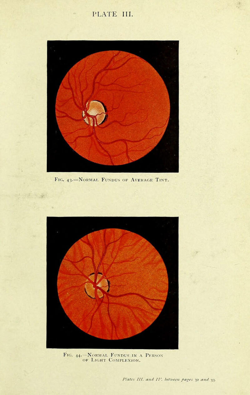 Fig. 43.—Normal Fundus of Avehage Tint. Fic;. 14. —Normal Fundus in a Pkrson OF Lk;ht Complexion.