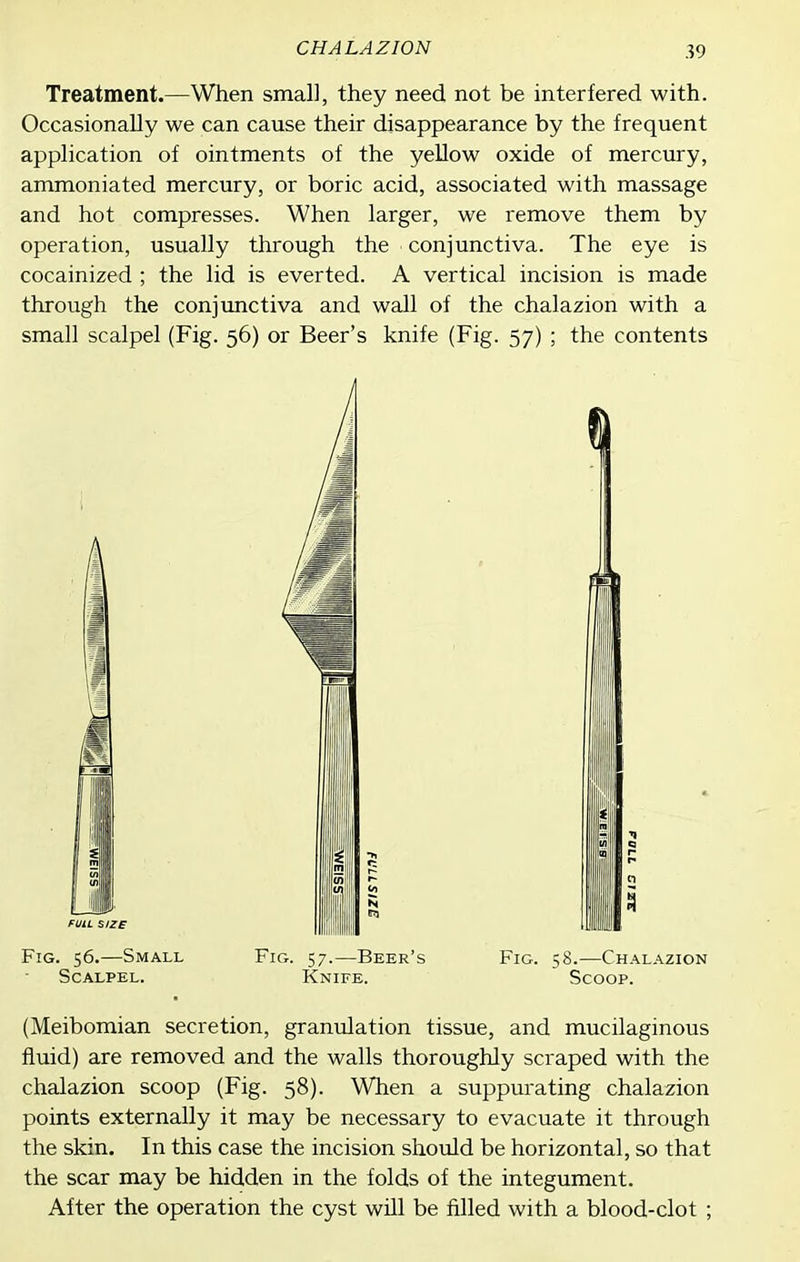 CHALAZION Treatment.—When smal], they need not be interfered with. Occasionally we can cause their disappearance by the frequent appHcation of ointments of the yellow oxide of mercury, ammoniated mercury, or boric acid, associated with massage and hot compresses. When larger, we remove them by operation, usually through the conjunctiva. The eye is cocainized ; the lid is everted. A vertical incision is made through the conjimctiva and wall of the chalazion with a small scalpel (Fig. 56) or Beer's knife (Fig. 57) ; the contents Fig. 56.—Small Fig. 57.—Beer's Fig. 58.—Chalazion Scalpel. Knife. Scoop. (Meibomian secretion, granrdation tissue, and mucilaginous fluid) are removed and the walls thoroughly scraped with the chalazion scoop (Fig. 58). When a suppurating chalazion points externally it may be necessary to evacuate it through the skin. In this case the incision should be horizontal, so that the scar may be hidden in the folds of the integument. After the operation the cyst will be filled with a blood-clot ;