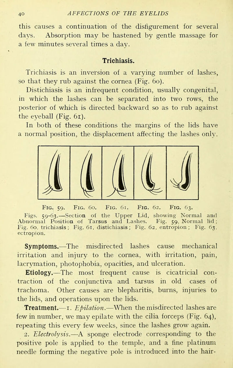this causes a continuation of the disfigurement for several days. Absorption may be hastened by gentle massage for a few minutes several times a day. Trichiasis. Trichiasis is an inversion of a varying number of lashes, so that they rub against the cornea (Fig. 60). Distichiasis is an infrequent condition, usually congenital, in which the lashes can be separated into two rows, the posterior of which is directed backward so as to rub against the eyeball (Fig. 61). In both of these conditions the margins of the lids have a normal position, the displacement affecting the lashes only. Fig. 59. Fig. 60. Fig. 61. Fig. 62. Fig. 63. Figs. 59-63.—Section of tlie Upper Lid, showing Normal and Abnormal Position of Tarsus and Lashes. Fig. 59, Normal lid; Fig. 60, trichiasis; Fig. 61, distichiasis; Fig. 62, entropion; Fig. 63, ectropion. Symptoms.—^The misdirected lashes cause mechanical irritation and injury to the cornea, with irritation, pain, lacrymation, photophobia, opacities, and ulceration. Etiology.—^The most frequent cause is cicatricial con- traction of the conjunctiva and tarsus in old cases of trachoma. Other causes are blepharitis, burns, injuries to the lids, and operations upon the lids. Treatment.—i. Epilation.—When the misdirected lashes are few in number, we may epilate with the cilia forceps (Fig. 64), repeating this every few weeks, since the lashes grow again. 2. Electrolysis.—A sponge electrode corresponding to the positive pole is applied to the temple, and a fine platinum needle forming the negative pole is introduced into the hair-