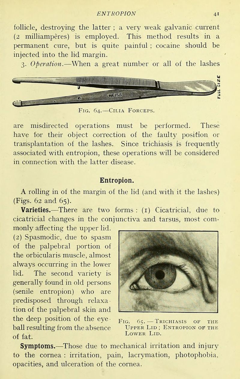 follicle, destroying the latter ; a very weak galvanic current (2 milliamperes) is employed. This method results in a permanent cure, but is quite painful ; cocaine should be injected into the lid margin. 3. Operation.—When a great number or all of the lashes Fig. 64.—Cilia Forceps. are misdirected operations must be performed. These have for their object correction of the faulty position or transplantation of the lashes. Since trichiasis is frequently associated with entropion, these operations will be considered in connection with the latter disease. Entropion. A rolling in of the margin of the lid (and with it the lashes) (Figs. 62 and 65). Varieties.—^There are two forms : (i) Cicatricial, due to cicatricial changes in the conjunctiva and tarsus, most com- monly affecting the upper lid. (2) Spasmodic, due to spasm of the palpebral portion of the orbicularis muscle, almost always occurring in the lower lid. The second variety is generally found in old persons (senile entropion) who are predisposed through relaxa ■ tion of the palpebral skin and the deep position of the eye- 65.-Trichiasis of the ball resrdting from the absence Upper Lid ; Entropion of the of fat Lower Lid. Symptoms.—^Those due to mechanical irritation and injury to the cornea : irritation, pain, lacrymation, photophobia, opacities, and ulceration of the cornea.