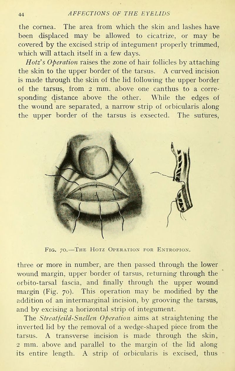 the cornea. The area from which the skin and lashes have been displaced may be allowed to cicatrize, or may be covered by the excised strip of integument properly trimmed, which will attach itself in a few days. Hotz's Operation raises the zone of hair follicles by attaching the skin to the upper border of the tarsus. A curved incision is made through the skin of the lid following the upper border of the tarsus, from 2 mm. above one canthus to a corre- sponding distance above the other. While the edges of the wound are separated, a narrow strip of orbicularis along the upper border of the tarsus is exsected. The sutures, Fig. 70.—The Hotz Operation for Entropion. three or more in number, are then passed through the lower wound margin, upper border of tarsus, returning through the orbito-tarsal fascia, and finally through the upper wound mai^gin (Fig. 70). This operation may be modified by the addition of an intermarginal incision, by grooving the tarsus, and by excising a horizontal strip of integument. The Streatfeild-Snellen Operation aims at straightening the inverted lid by the removal of a wedge-shaped piece from the tarsus. A transverse incision is made through the skin, 2 mm. above and parallel to the margin of the lid along its entire length. A strip of orbicularis is excised, thus -