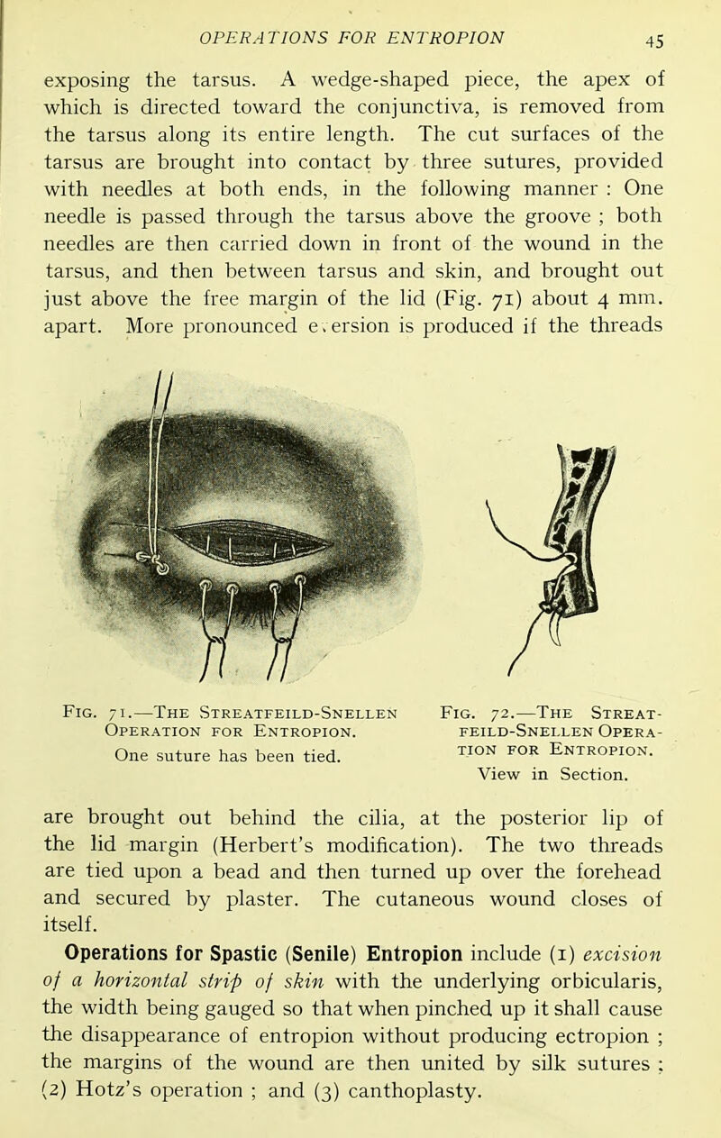 exposing the tarsus. A wedge-shaped piece, the apex of which is directed toward the conjunctiva, is removed from the tarsus along its entire length. The cut surfaces of the tarsus are brought into contact by three sutures, provided with needles at both ends, in the following manner : One needle is passed through the tarsus above the groove ; both needles are then carried down in front of the wound in the tarsus, and then between tarsus and skin, and brought out just above the free margin of the lid (Fig. 71) about 4 mm. apart. More pronounced e . ersion is produced if the threads are brought out behind the cilia, at the posterior lip of the lid margin (Herbert's modification). The two threads are tied upon a bead and then turned up over the forehead and secured by plaster. The cutaneous wound closes of itself. Operations for Spastic (Senile) Entropion include (i) excision of a horizontal strip of skin with the underlying orbicularis, the width being gauged so that when pinched up it shall cause the disappearance of entropion without producing ectropion ; the margins of the wound are then united by silk sutures : (2) Hotz's operation ; and (3) canthoplasty. Fig. 71.—The Streatfeild-Snellen Operation for Entropion. One suture has been tied. Fig. 72.—The Streat- feild-Snei.len Opera- tion for Entropion. View in Section.