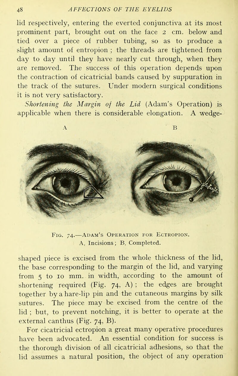 lid respectively, entering the everted conjunctiva at its most prominent part, brought out on the face 2 cm. below and tied over a piece of rubber tubing, so as to produce a slight amount of entropion ; the threads are tightened from day to day until they have nearly cut through, when they are removed. The success of this operation depends upon the contraction of cicatricial bands caused by suppuration in the track of the sutures. Under modern surgical conditions it is not very satisfactory. Shortening the Margin of the Lid (Adam's Operation) is applicable when there is considerable elongation. A wedge- A B . Fig. 74.—Adam's Operation for Ectropion. A, Incisions; B, Completed. shaped piece is excised from the whole thickness of the lid, the base corresponding to the margin of the lid, and varying from 5 to 10 mm. in width, according to the amount of shortening required (Fig. 74, A) ; the edges are brought together by a hare-lip pin and the cutaneous margins by silk sutures. The piece may be excised from the centre of the lid ; but, to prevent notching, it is better to operate at the external canthus (Fig. 74, B). For cicatricial ectropion a great many operative procedures have been advocated. An essential condition for success is the thorough division of all cicatricial adhesions, so that the lid assumes a natural position, the object of any operation