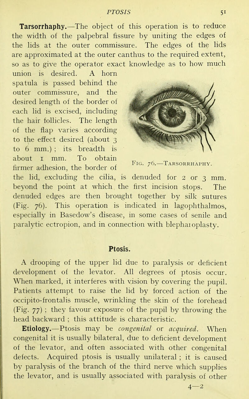 Tarsorrhaphy.—The object of this operation is to reduce the width of the palpebral fissure by uniting the edges of the lids at the outer commissure. The edges of the lids are approximated at the outer canthus to the required extent, so as to give the operator exact knowledge as to how much union is desired. A horn spatula is passed behind the outer commissure, and the desired length of the border of each lid is excised, including the hair follicles. The length of the flap varies according to the effect desired (about 3 to 6 mm.) ; its breadth is about I mm. To obtain „ n • ,,11 r Fig. 76.—Tarsorrhaphy. firmer adhesion, the border of the lid, excluding the cilia, is denuded for 2 or 3 mm. beyond the point at which the first incision stops. The denuded edges are then brought together by silk sutures (Fig. 76). This operation is indicated in lagophthalmos, especially in Basedow's disease, in some cases of senile and paralytic ectropion, and in connection with blephaioplasty. Ptosis. A drooping of the upper lid due to paralysis or deficient development of the levator. All degrees of ptosis occur. When marked, it interferes with vision by covering the pupil. Patients attempt to raise the lid by forced action of the occipito-frontalis muscle, wrinkling the skin of the forehead (Fig. 77) ; they favour exposure of the pupil by throwing the head backward ; this attitude is characteristic. Etiology.—Ptosis may be congenital or acquired. When congenital it is usually bilateral, due to deficient development of the levator, and often associated with other congenital defects. Acquired ptosis is usually unilateral ; it is caused by paralysis of the branch of the third nerve which supplies the levator, and is usually associated with paralysis of other 4—2