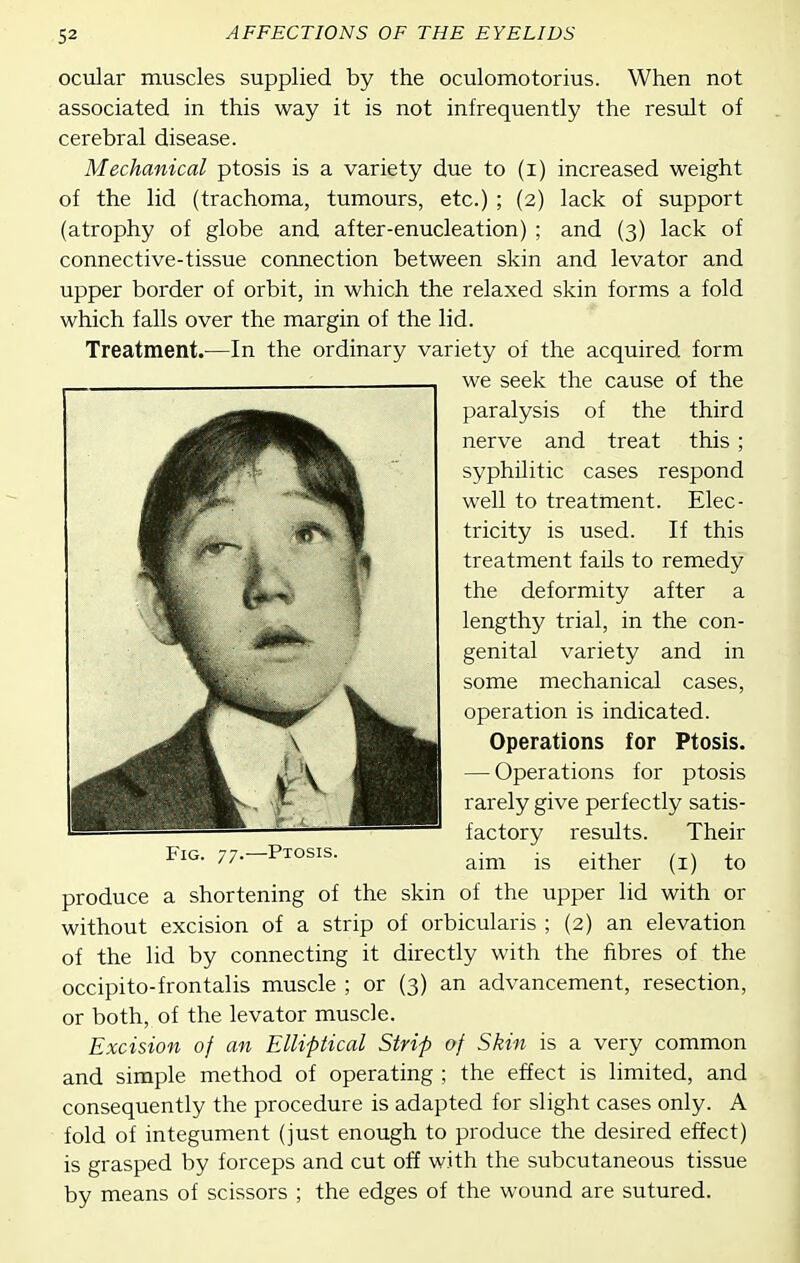 ocular muscles supplied by the oculomotorius. When not associated in this way it is not infrequently the result of cerebral disease. Mechanical ptosis is a variety due to (i) increased weight of the lid (trachoma, tumours, etc.) ; (2) lack of support (atrophy of globe and after-enucleation) ; and (3) lack of connective-tissue connection between skin and levator and upper border of orbit, in which the relaxed skin forms a fold which falls over the margin of the lid. Treatment.—In the ordinary variety of the acquired form without excision of a strip of orbicularis ; (2) an elevation of the lid by connecting it directly with the fibres of the occipito-frontalis muscle ; or (3) an advancement, resection, or both, of the levator muscle. Excision of an Elliptical Strip of Skin is a very common and simple method of operating ; the effect is limited, and consequently the procedure is adapted for slight cases only. A fold of integument (just enough to produce the desired effect) is grasped by forceps and cut off with the subcutaneous tissue by means of scissors ; the edges of the wound are sutured. we seek the cause of the paralysis of the third nerve and treat this ; syphilitic cases respond well to treatment. Elec- tricity is used. If this treatment fails to remedy the deformity after a lengthy trial, in the con- genital variety and in some mechanical cases, operation is indicated. Fig. 77.—Ptosis. produce a shortening of the skin Operations for Ptosis. — Operations for ptosis rarely give perfectly satis- factory results. Their aim is either (i) to of the upper lid with or