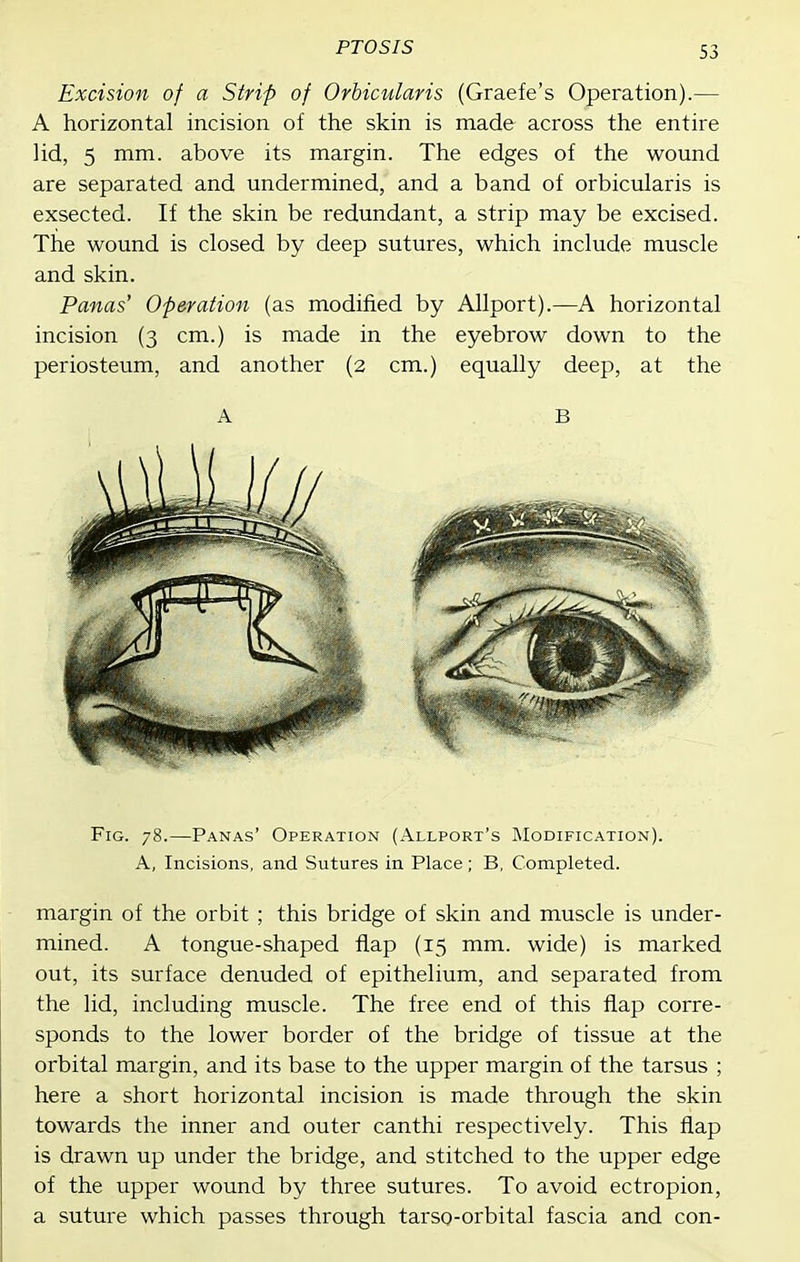 Excision of a Strip of Orbicularis (Graefe's Operation).— A horizontal incision of the skin is made across the entire lid, 5 mm. above its margin. The edges of the wound are separated and undermined, and a band of orbicularis is exsected. If the skin be redundant, a strip may be excised. The wound is closed by deep sutures, which include muscle and skin. Panas' Operation (as modified by Allport).—A horizontal incision (3 cm.) is made in the eyebrow down to the periosteum, and another (2 cm.) equally deep, at the Fig. 78.—Panas' Operation (Allport's Modification). A, Incisions, and Sutures in Place; B, Completed. margin of the orbit ; this bridge of skin and muscle is under- mined. A tongue-shaped flap (15 mm. wide) is marked out, its surface denuded of epithelium, and separated from the lid, including muscle. The free end of this flap corre- sponds to the lower border of the bridge of tissue at the orbital margin, and its base to the upper margin of the tarsus ; here a short horizontal incision is made through the skin towards the inner and outer canthi respectively. This flap is drawn up under the bridge, and stitched to the upper edge of the upper wound by three sutures. To avoid ectropion, a suture which passes through tarso-orbital fascia and con- A B