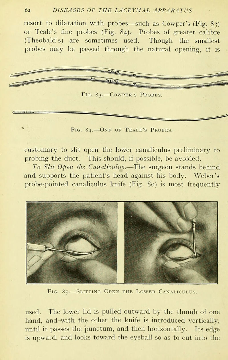 resort to dilatation with probes—such as Cowper's (Fig. 83) or Teak's fine probes (Fig. 84). Probes of greater calibre (Theobald's) are sometimes used. Though the smallest probes may be passed through the natural opening, it is Fig. 83.—Cowper's Probes. Fig. 84.—One of Teale's Probes. customary to slit open the lower canaliculus preliminary to probing the duct. This should, if possible, be avoided. To Slit Open the Canaliculus.—The surgeon stands behind and supports the patient's head against his body. Weber's probe-pointed canaliculus knife (Fig. 80) is most frequently Fig. 85.—Slittixg Ope.ni the Lower Canaliculus. used. The lower lid is pulled outward by the thumb of one hand, and-with the other the knife is introduced vertically, until it passes the punctum, and then horizontally. Its edge is upward, and looks toward the eyeball so as to cut into the