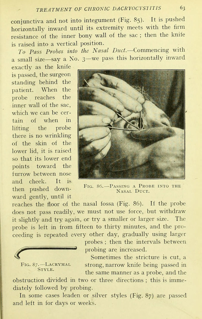 conjunctiva and not into integument (Fig. 85). It is pushed horizontally inward until its extremity meets with the firm resistance of the inner bony wall of the sac ; then the knife is raised into a vertical position. To Pass Probes into the Nasal Duct.—Commencing with a small size—say a No. 3—we pass this horizontally inward exactly as the knife is passed, the surgeon standing behind the patient. When the probe reaches the inner wall of the sac, which we can be cer- tain of when in Fig. 86. -Passing a Probe into the Nasal Duct. lifting the probe there is no wrinkling of the skin of the lower lid, it is raised so that its lower end points toward the furrow between nose and cheek. It is then pushed down- ward gently, until it reaches the floor of the nasal fossa (Fig. 86). If the probe does not pass readily, we must not use force, but withdraw it slightly and try again, or try a smaller or larger size. The probe is left in from fifteen to thirty minutes, and the pro- ceeding is repeated every other day, gradually using larger probes ; then the intervals between probing are increased. Sometimes the stricture is cut, a strong, narrow knife being passed in the same manner as a probe, and the obstruction divided in two or three directions ; this is imme- diately followed by probing. In some cases leaden or silver styles (Fig. 87) are passed and left in for days or weeks. 7.—Lacrymal Style.