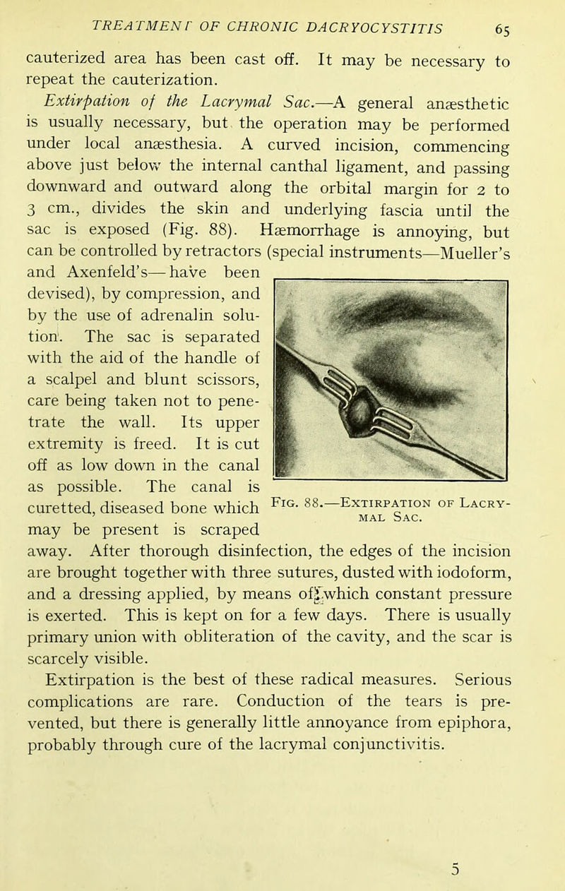 off. It may be necessary to cauterized area has been cast repeat the cauterization. Extirpation of the Lacrymal Sac.—A general anjesthetic is usually necessary, but the operation may be performed under local anaesthesia. A curved incision, commencing above just below the internal can thai ligament, and passing downward and outward along the orbital margin for 2 to 3 cm., divides the skin and underlying fascia until the sac is exposed (Fig. 88). Hsemorrhage is annoying, but can be controlled by retractors (special instruments—Mueller's and Axenfeld's—have been devised), by compression, and by the use of adrenalin solu- tion. The sac is separated with the aid of the handle of a scalpel and blunt scissors, care being taken not to pene- trate the wall. Its upper extremity is freed. It is cut off as low down in the canal as possible. The canal is curetted, diseased bone which may be present is scraped away. After thorough disinfection, the edges of the incision are brought together with three sutures, dusted with iodoform, and a dressing applied, by means ofj'which constant pressure is exerted. This is kept on for a few days. There is usually primary union with obliteration of the cavity, and the scar is scarcely visible. Extirpation is the best of these radical measures. Serious complications are rare. Conduction of the tears is pre- vented, but there is generally little annoyance from epiphora, probably through cure of the lacrymal conjunctivitis. Fig. -Extirpation of Lacry- mal Sac. 5