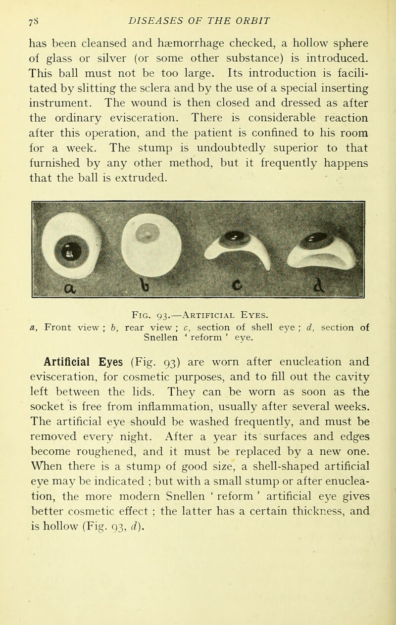 has been cleansed and haemorrhage checked, a hollow sphere of glass or silver (or some other substance) is introduced. This ball must not be too large. Its introduction is facili- tated by slitting the sclera and by the use of a special inserting instrument. The wound is then closed and dressed as after the ordinary evisceration. There is considerable reaction after this operation, and the patient is confined to his room for a week. The stump is undoubtedly superior to that furnished by any other method, but it frequently happens that the ball is extruded. Fig. 93.—Artificial Eyes. a. Front view ; b, rear view ; c, section of shell eye ; d, section of Snellen ' reform ' eye. Artificial Eyes (Fig. 93) are worn after enucleation and evisceration, for cosmetic purposes, and to fill out the cavity left between the lids. They can be worn as soon as the socket is free from inflammation, usually after several weeks. The artificial eye should be washed frequently, and must be removed every night. After a year its surfaces and edges become roughened, and it must be replaced by a new one. When there is a stump of good size, a shell-shaped artificial eye may be indicated ; but with a small stump or after enuclea- tion, the more modern Snellen ' reform ' artificial eye gives better cosmetic effect ; the latter has a certain thickness, and is hollow (Fig. 93, d).
