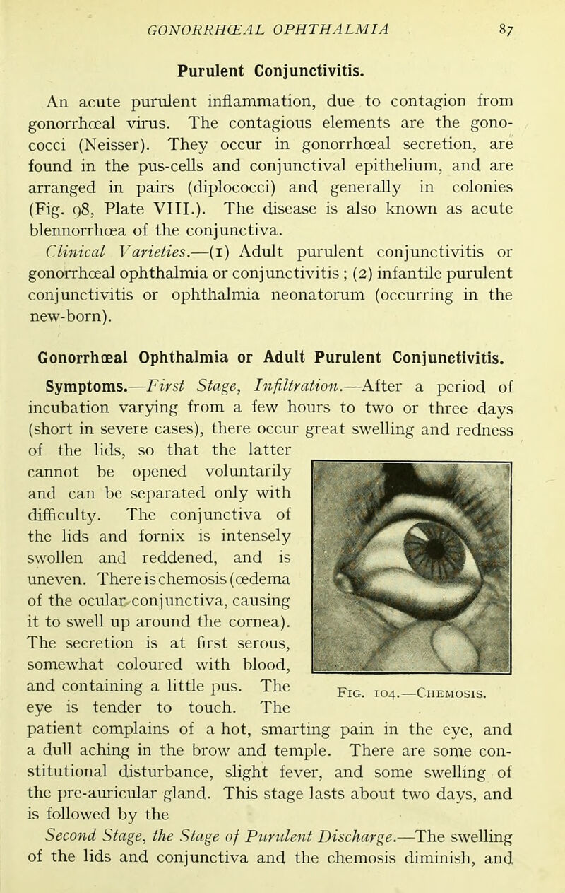 Purulent Conjunctivitis. An acute purulent inflammation, due to contagion from gonorrhoeal virus. The contagious elements are the gono- cocci (Neisser). They occur in gonorrhoeal secretion, are found in the pus-cells and conjunctival epithelium, and are arranged in pairs (diplococci) and generally in colonies (Fig. 98, Plate VIII.). The disease is also known as acute blennorrhcea of the conjunctiva. Clinical Varieties.—(i) Adult purulent conjunctivitis or gonorrhoeal ophthalmia or conjunctivitis ; (2) infantile purulent conjunctivitis or ophthalmia neonatorum (occurring in the new-born). Gonorrhoeal Ophthalmia or Adult Purulent Conjunctivitis. Symptoms.—First Stage, Infiltration.—After a period of incubation varying from a few hours to two or three days (short in severe cases), there occur great swelling and redness of the lids, so that the latter cannot be opened voluntarily and can be separated only with difficulty. The conjunctiva of the lids and fornix is intensely swollen and reddened, and is uneven. There is chemosis (oedema of the ocular, conjunctiva, causing it to swell up around the cornea). The secretion is at first serous, somewhat coloured with blood, and containing a little pus. The eye is tender to touch. The patient complains of a hot, smarting pain in the eye, and a dull aching in the brow and temple. There are some con- stitutional disturbance, slight fever, and some swelling of the pre-auricular gland. This stage lasts about two days, and is followed by the Second Stage, the Stage of Purulent Discharge.—^The swelling of the lids and conjunctiva and the chemosis diminish, and Fig. 104.—Chemosis.