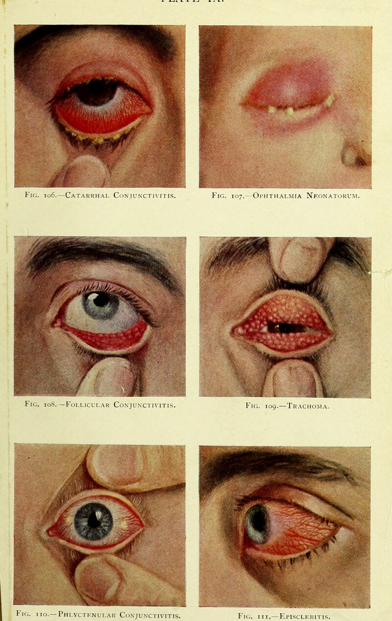 Fig. io6.—Catarrhal Conjunxtivitis. Fig. 107.—Ophthalmia Neonatoium. 2 f'*- o—Phlyctf.nui.ar Conjunctivitis. Fig. hi.—Episcleritis.