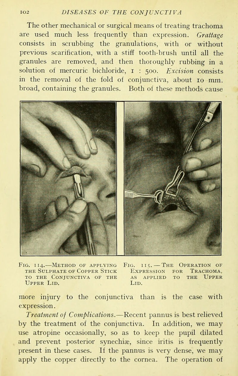The other mechanical or surgical means of treating trachoma are used much less frequently than expression. Grattage consists in scrubbing the granulations, with or without previous scarification, with a stiff tooth-brush until all the granules are removed, and then thoroughly rubbing in a solution of mercuric bichloride, i : 500. Excision consists in the removal of the fold of conjunctiva, about 10 mm. broad, containing the granules. Both of these methods cause Fig. 114.—Method of applying Fig. 115.—The Operation of THE Sulphate of Copper Stick Expression for Trachoma, TO THE Conjunctiva of the as applied to the Upper Upper Lid. Lid. more injury to the conjunctiva than is the case with expression. Treatment of Complications.—Recent pannus is best relieved by the treatment of the conjunctiva. In addition, we may use atropine occasionally, so as to keep the pupil dilated and prevent posterior synechiae, since iritis is frequently present in these cases. If the pannus is very dense, we may apply the copper directly to the cornea. The operation of
