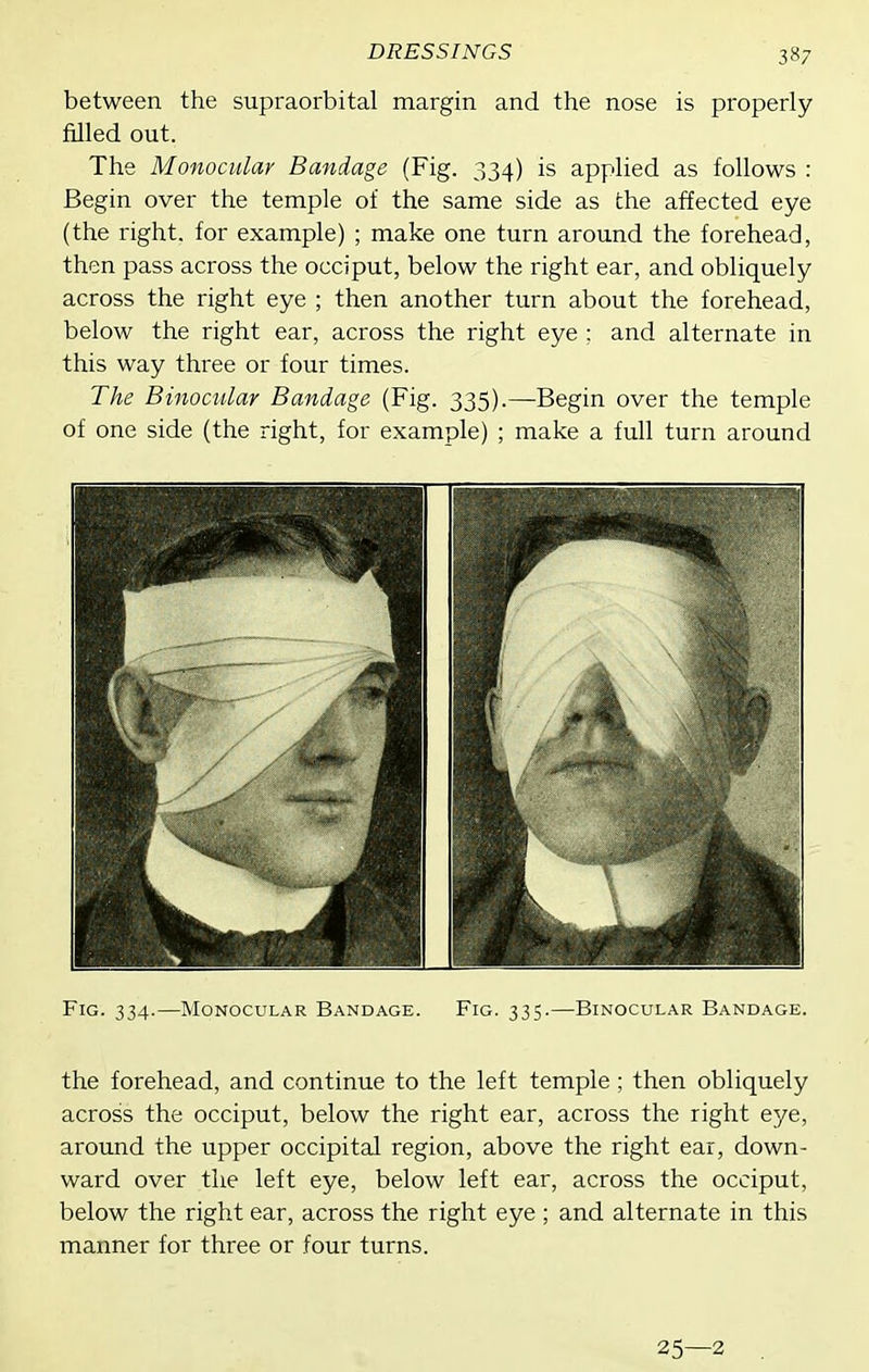 between the supraorbital margin and the nose is properly- filled out. The Monocular Bandage (Fig. 334) is applied as follows : Begin over the temple of the same side as the affected eye (the right, for example) ; make one turn around the forehead, then pass across the occiput, below the right ear, and obliquely across the right eye ; then another turn about the forehead, below the right ear, across the right eye ; and alternate in this way three or four times. The Bhiocular Bandage (Fig. 335).—Begin over the temple of one side (the right, for example) ; make a full turn around Fig. 334.—Monocular Bandage. Fig. 335.—Binocular Bandage. the forehead, and continue to the left temple ; then obliquely across the occiput, below the right ear, across the right eye, around the upper occipital region, above the right ear, down- ward over the left eye, below left ear, across the occiput, below the right ear, across the right eye ; and alternate in this manner for three or four turns. 25—2